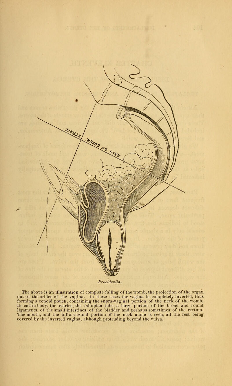 Procidentia. The above is an illustration of complete falling; of the womb, the projection of the organ out of the orifice of the vagina. In these cases the vagina is completely inverted, thus forming a conoid pouch, containing the supra-vaginal portion of the neck of the womb, its entire body, the ovaries, the fallopian tube, a large portion of the broad and round ligaments, of the small intestines, of the bladder and perhaps sometimes of the rectum. The mouth, and the infra-vaginal portion of the neck alone is seen, all the rest being covered by the inverted vagina, although protruding beyond the vulva.