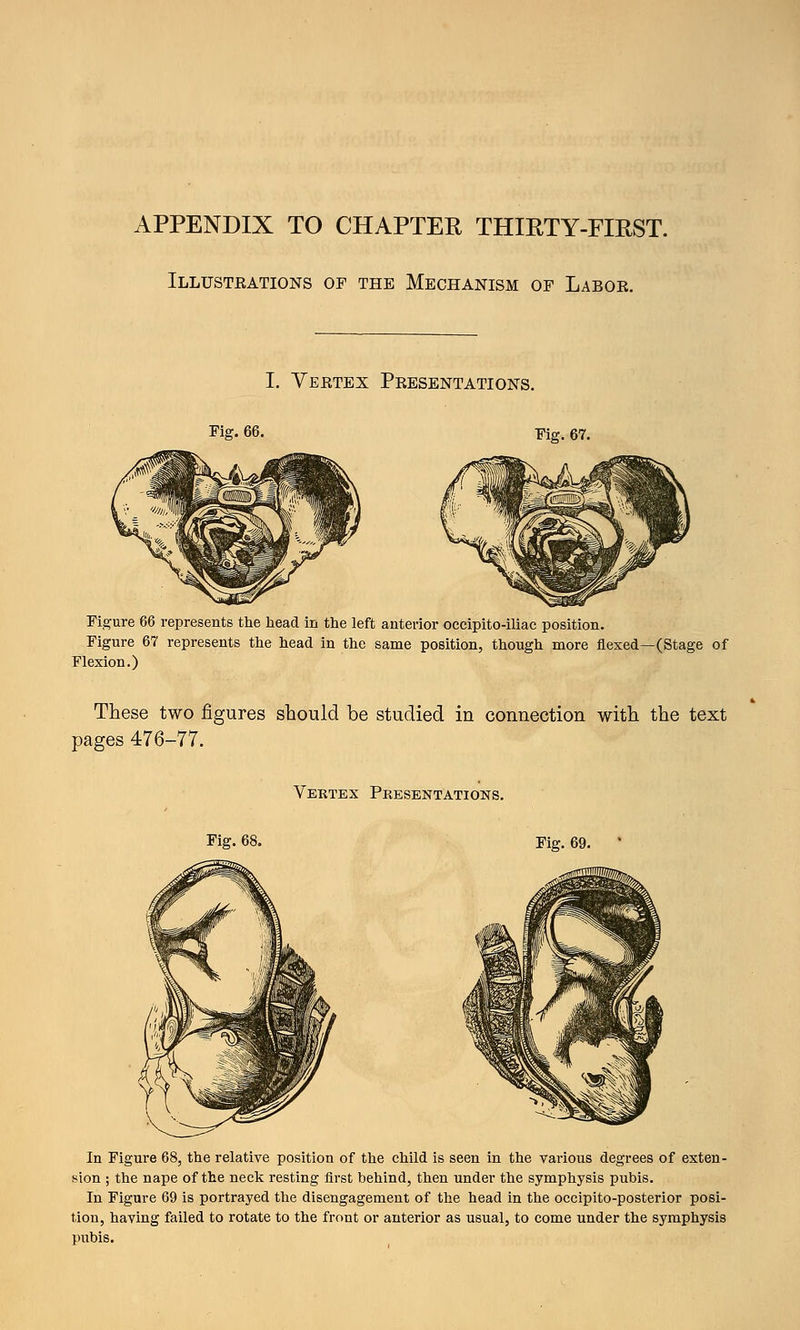 APPENDIX TO CHAPTER THIRTY-FIRST. Illusteations of the Mechanism of Laboe. I. Yeetex Peesentations. Fig- 66. Fig. 67. Figure 66 represents the head in the left anterior occipito-iliac position. Figure 67 represents the head in the same position, though more flexed—(Stage of Flexion.) These two figures should be studied in connection with the text pages 476-77. Vertex Presentations. Fig. 68. Fig. 69. ' In Figure 68, the relative position of the child is seen in the various degrees of exten- sion ; the nape of the neck resting first behind, then under the symphysis pubis. In Figure 69 is portrayed the disengagement of the head in the occipito-posterior posi- tion, having failed to rotate to the front or anterior as usual, to come under the symphysis pubis.