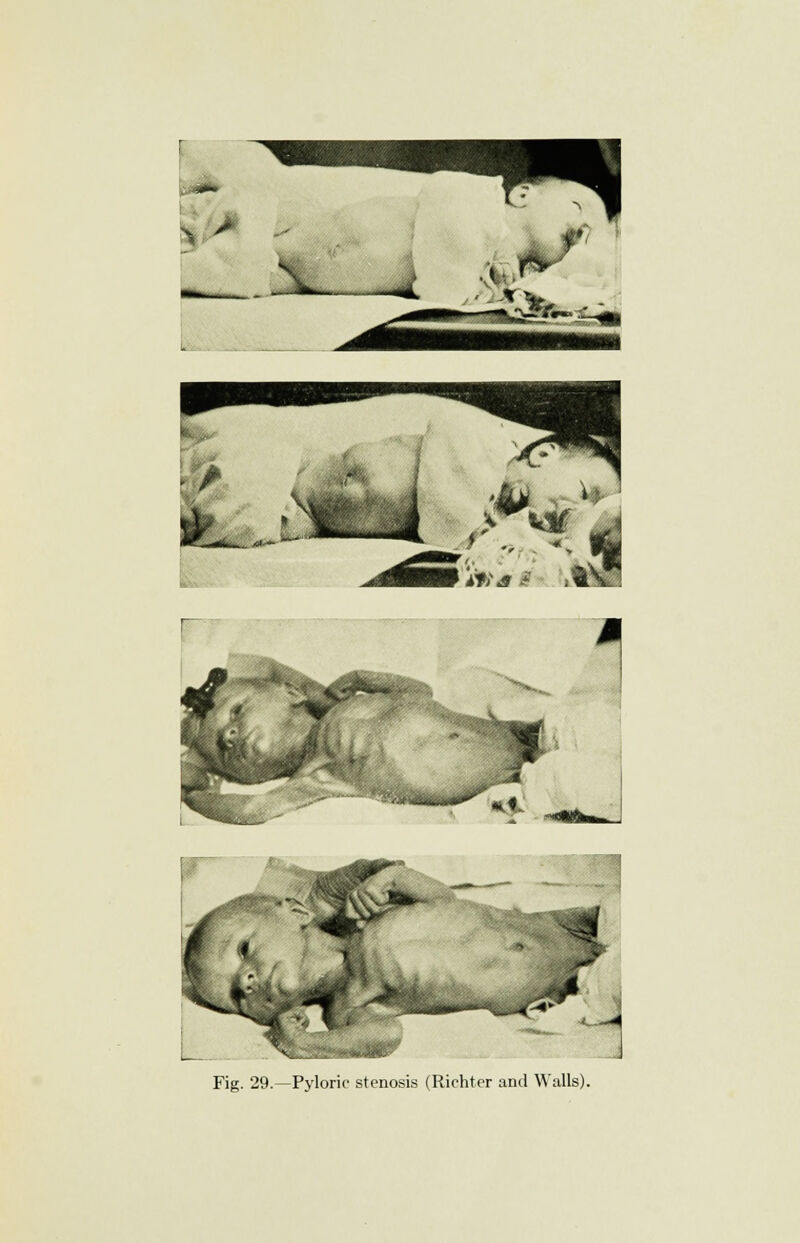 » 4 ' ikfcf^ 0 ;t ^' *« 1 ■-^fWi Fig. 29.—Pyloric stenosis (Richter and Walls).