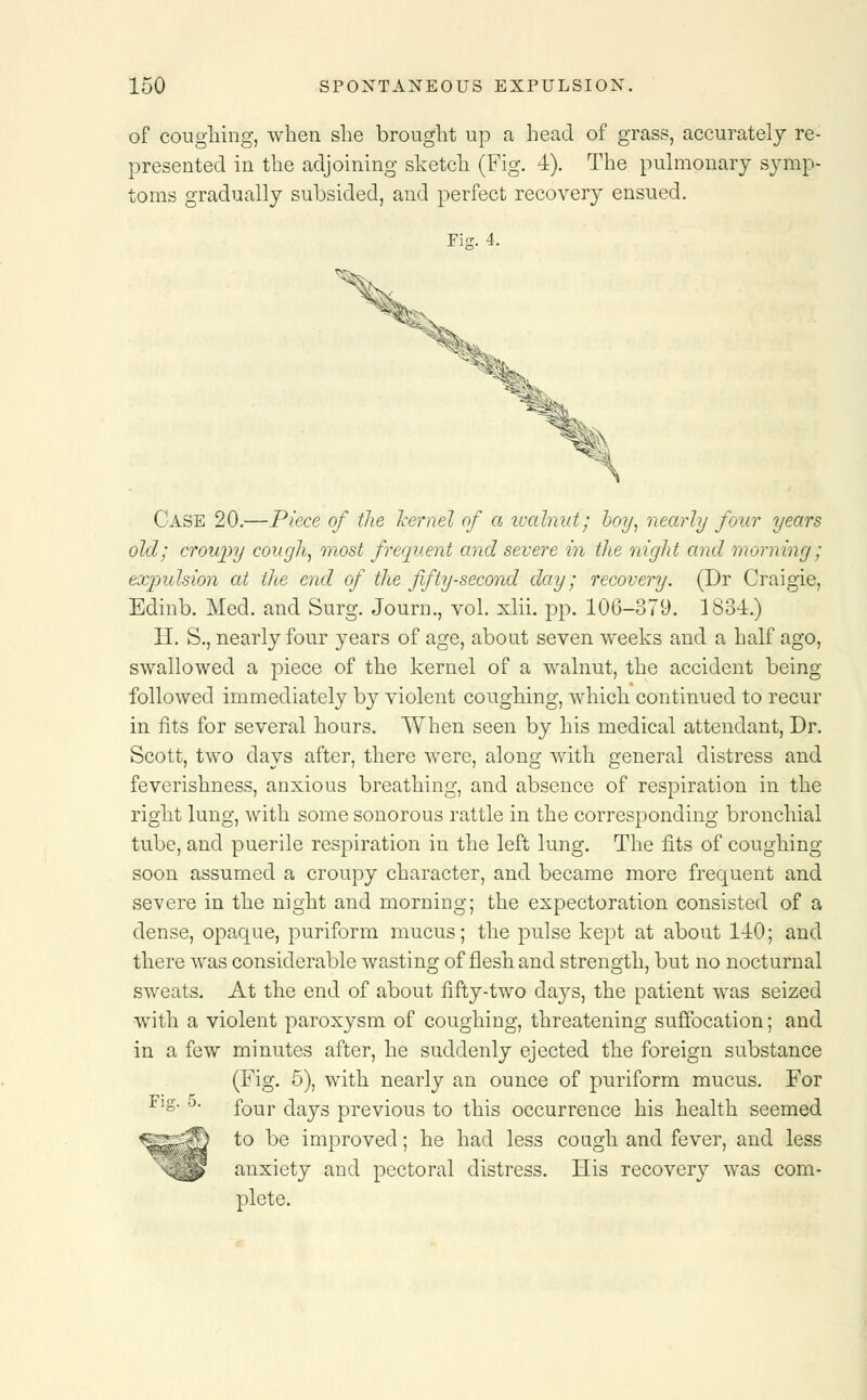 of coughing, when she brought up a head of grass, accurately re presented in the adjoining sketch (Fig. 4). The pulmonary symp toms gradually subsided, and perfect recovery ensued. Fin. 4. Case 20.—Piece of the kernel of a walnut; boy, nearly four years old; croupy cough, most frequent and severe in the night and morning; expulsion at the end of the fifty-second day; recovery. (Dr Craigie, Edinb. Med. and Surg. Journ., vol. xlii. pp. 106-379. 1834.) H. S., nearly four years of age, about seven weeks and a half ago, swallowed a piece of the kernel of a walnut, the accident being followed immediately by violent coughing, which continued to recur in fits for several hours. When seen by his medical attendant, Dr. Scott, two days after, there were, along with general distress and feverishness, anxious breathing, and absence of respiration in the right lung, with some sonorous rattle in the corresponding bronchial tube, and puerile respiration in the left lung. The fits of coughing soon assumed a croupy character, and became more frequent and severe in the night and morning; the expectoration consisted of a dense, opaque, puriform mucus; the pulse kept at about 110; and there was considerable wasting of flesh and strength, but no nocturnal sweats. At the end of about fifty-two days, the patient was seized with a violent paroxysm of coughing, threatening suffocation; and in a few minutes after, he suddenly ejected the foreign substance (Fig. 5), with nearly an ounce of puriform mucus. For Flg- four days previous to this occurrence his health seemed to be improved; he had less cough and fever, and less anxiety and pectoral distress. His recovery was com- plete.