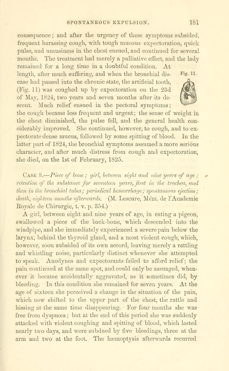 consequence; and after the urgency of these symptoms subsided, frequent harassing cough, with tough mucous expectoration, quick pulse, and uneasiness in the chest ensued, and continued for several month's. The treatment had merely a palliative effect, and the lady remained for a long time in a doubtful condition. At length, after much suffering, and when the bronchial dis- FiS- H- ease had passed into the chronic state, the artificial tooth, (Fig. 11) was coughed up by expectoration on the 23d of May, 1824, two years and seven months after its de- scent. Much relief ensued in the pectoral symptoms; the cough became less frequent and urgent; the sense of weight in the chest diminished, the pulse fell, and the general health con- siderably improved. She continued, however, to cough, and to ex- pectorate dense mucus, followed by some spitting of blood. In the latter part of 1824, the bronchial symptoms assumed a more serious character, and after much distress from cough and expectoration, she died, on the 1st of February, 1825. Case 8.—Piece of hone; girl, hetween eight and nine years of age : retention of the substance for seventeen years, first in the trachea, and then in the bronchial tubes; periodical hemorrhage; spontaneous ejection; death, eighteen mont/is afterwards. (M. Lescure, Mem. de l'Academie Eoyale de Chirurgie, t. v. p. 354.) A girl, between eight and nine years of age, in eating a pigeon, swallowed a piece of the back-bone, which descended into the windpipe, and she immediately experienced a severe pain below the larynx, behind the thyroid gland, and a most violent cough, which, however, soon subsided of its own accord, leaving merely a rattling and whistling noise, particularly distinct whenever she attempted to speak. Anodynes and expectorants failed to afford relief; the pain continued at the same spot, and could only be assuaged, when- ever it became accidentally aggravated, as it sometimes did, by bleeding. In this condition she remained for seven years. At the age of sixteen she perceived a change in the situation of the pain, which now shifted to the upper part of the chest, the rattle and hissing at the same time disappearing. For four months she was free from dyspnoea; but at the end of this period she was suddenly attacked with violent coughing and spitting of blood, which lasted nearly two days, and were subdued by five bleedings, three at the arm and two at the foot. The haemoptysis afterwards recurred