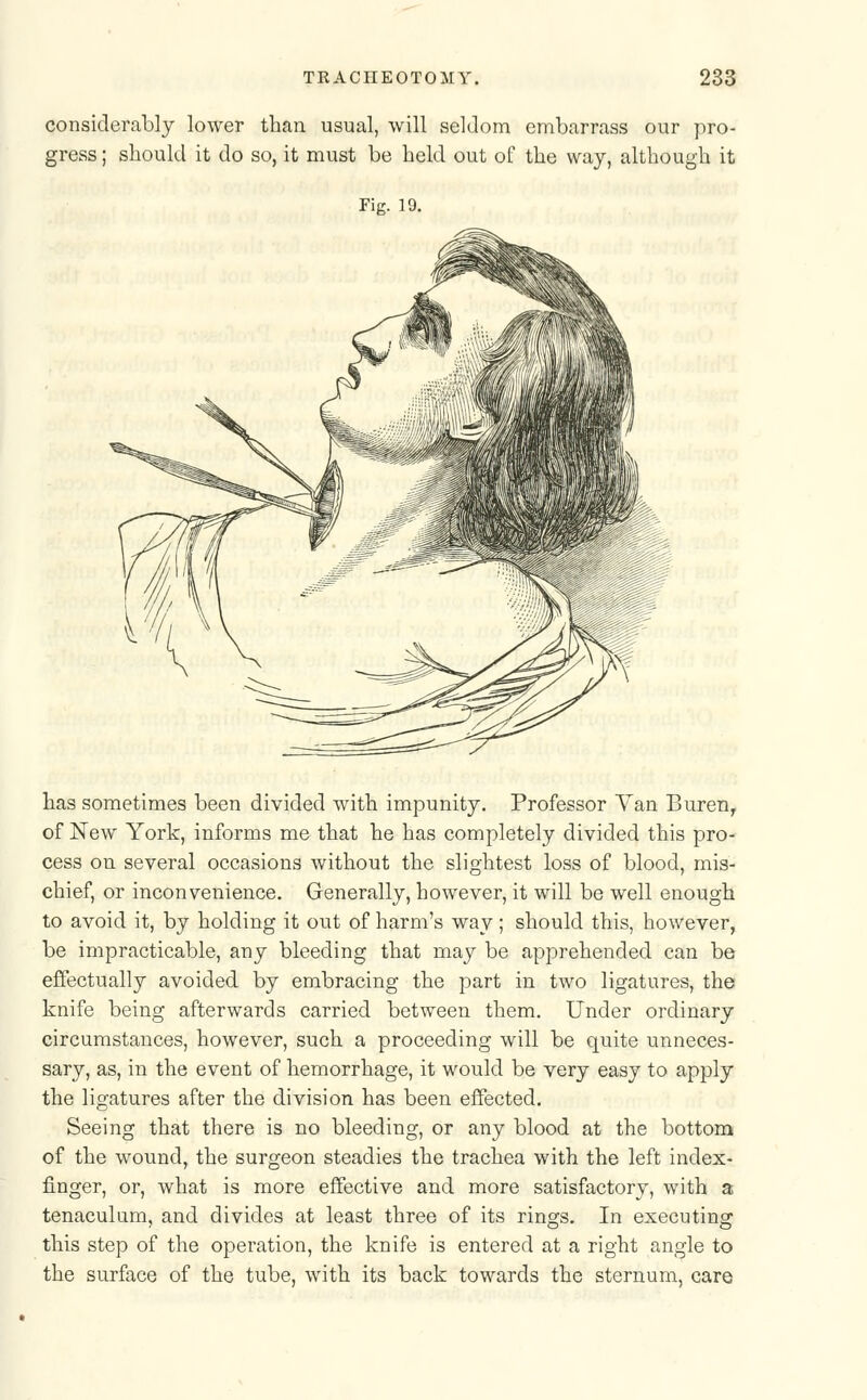 considerably lower than usual, will seldom embarrass our pro- gress ; should it do so, it must be held out of the way, although it Fig. 19. has sometimes been divided with impunity. Professor Van Buren, of New York, informs me that he has completely divided this pro- cess on several occasions without the slightest loss of blood, mis- chief, or inconvenience. Generally, however, it will be well enough to avoid it, by holding it out of harm's way; should this, however, be impracticable, any bleeding that may be apprehended can be effectually avoided by embracing the part in two ligatures, the knife being afterwards carried between them. Under ordinary circumstances, however, such a proceeding will be quite unneces- sary, as, in the event of hemorrhage, it would be very easy to apply the ligatures after the division has been effected. Seeing that there is no bleeding, or any blood at the bottom of the wound, the surgeon steadies the trachea with the left index- finger, or, what is more effective and more satisfactory, with a tenaculum, and divides at least three of its rings. In executing this step of the operation, the knife is entered at a right angle to the surface of the tube, with its back towards the sternum, care