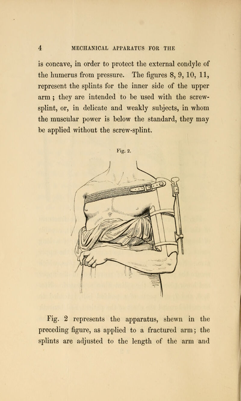 is concave, in order to protect the external condyle of the humerus from pressure. The figures 8, 9, 10, 11, represent the splints for the inner side of the upper arm; they are intended to be used with the screw- splint, or, in delicate and weakly subjects, in whom the muscular power is below the standard, they may be applied without the screw-splint. Fig. 2. Fig. 2 represents the apparatus, shewn in the preceding figure, as applied to a fractured arm; the splints are adjusted to the length of the arm and