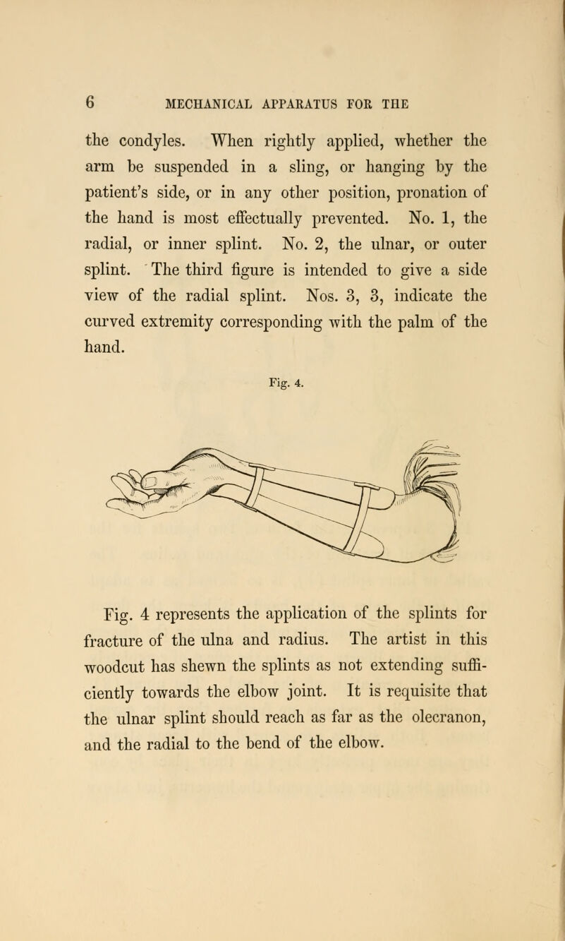 the condyles. When rightly applied, whether the arm be suspended in a sling, or hanging by the patient's side, or in any other position, pronation of the hand is most effectually prevented. No. 1, the radial, or inner splint. No. 2, the ulnar, or outer splint. The third figure is intended to give a side view of the radial splint. Nos. 3, 3, indicate the curved extremity corresponding with the palm of the hand. Fig. 4. Fig. 4 represents the application of the splints for fracture of the ulna and radius. The artist in this woodcut has shewn the splints as not extending suffi- ciently towards the elbow joint. It is requisite that the ulnar splint should reach as far as the olecranon, and the radial to the bend of the elbow.