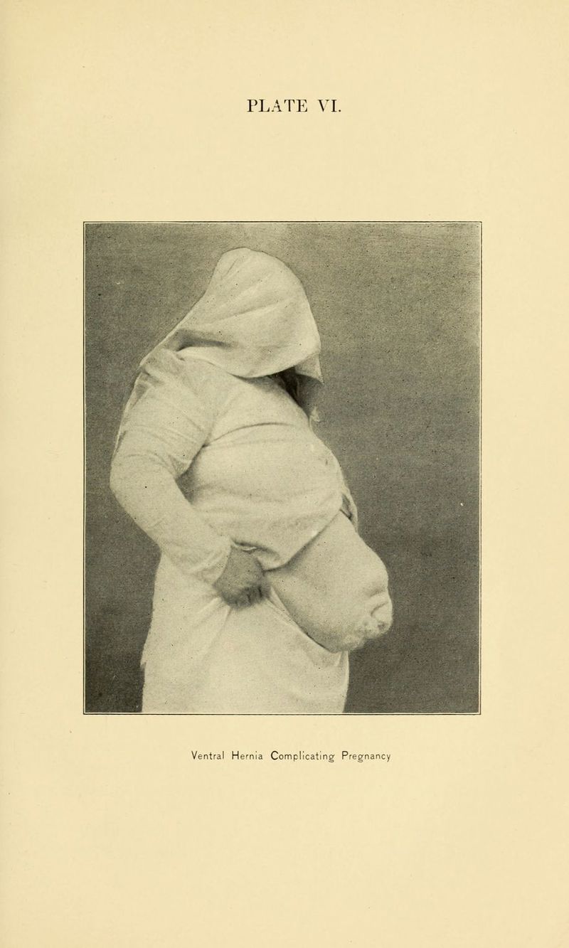 Ventral Hernia Complicating Pregnancy