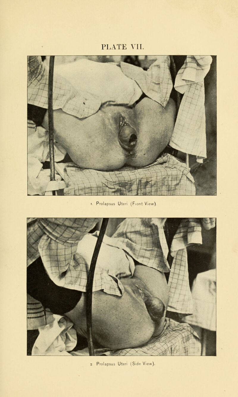 !, Prolapsus Uteri (Front View), 2 Prolapsus Uteri (Side View).