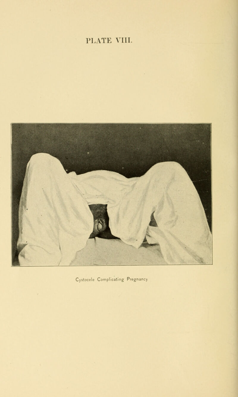 Cystocele Complicating Pregnancy