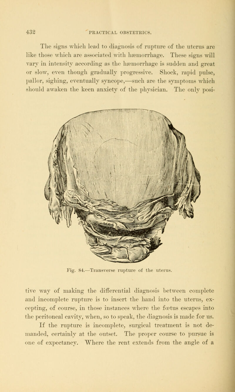 The signs which lead to diagnosis of rupture of the uterus are like those which are associated with haemorrhage. These signs will vary in intensity according as the haemorrhage is sudden and great or slow, even though gradually progressive. Shock, rapid pulse, pallor, sighing, eventually syncope,—such are the symptoms which should awaken the keen anxiety of the physician. The only posi- Fig. 84.—Transverse rupture of the uterus. tive way of making the differential diagnosis between complete and incomplete rupture is to insert the hand into the uterus, ex- cepting, of course, in those instances where the foetus escapes into the peritoneal cavity, when, so to speak, the diagnosis is made for us. If the rupture is incomplete, surgical treatment is not de- manded, certainly at the outset. The proper course to pursue is one of expectancy. Where the rent extends from the angle of a