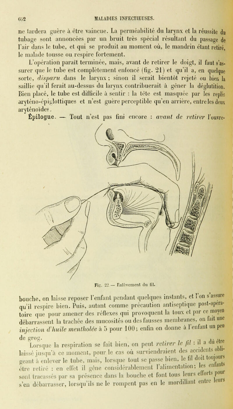 ne lardera guère à être vaincue. La perméabilité du larynx et la réussite du tubage sont annoncées par un bruit très spécial résultant du passage de l'air dans le tube, et qui se produit au moment où, le mandrin étant retiré, le malade tousse ou respire fortement. L'opération parait terminée, mais, avant de retirer le doigt, il faut s'as- surer que le tube est complètement enfoncé (fig. 21) et qu'il a, en quelque sorte, disparu dans le larynx ; sinon il serait bientôt rejeté ou bien la saillie qu'il ferait au-dessus du larynx contribuerait à gêner la déglutition. Bien placé, le tube est difficile à sentir : la tête est masquée par les repli; aryténo-épiglottiques et n'est guère perceptible qu'en arrière, entre les deux aryténoïdes. Épilogue. — Tout n'est pas fini encore : avant de retirer l'ouvre- Fis. il — Enlèvement du fil. bouche, on laisse reposer l'enfant pendant quelques instants, et l'on s'assure qu'il respire bien. Puis, autant comme précaution antiseptique post-opera- toire que pour amener des réflexes qui provoquent la toux et par ce moyen débarrassent la trachée des mucosités ou des fausses membranes, on fait une injection d'huile mentholée à 5 pour 100; enfin on donne à l'enfant un peu Lorsque la respiration se fait bien, on peut retirer le fil : il a au être laissé jusqu'à ce moment, pour le cas où surviendraient des accidents obli- geante enlever le tube, mais, lorsque tout se passe bien, le fil doit toujours être retiré : en effet il gêne considérablement l'alimentation; les entama soni tracassés par sa présence dans la bouche et font tous leurs efforts pour s'en débarrasser, lorsqu'ils ne le rompent pas en le mordillant entre leurs