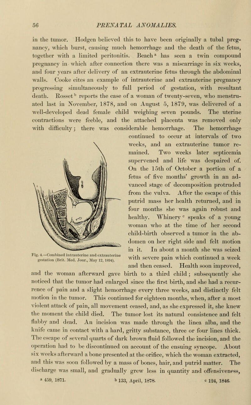 in the tumor. Hodgen believed this to have been originally a tubal preg- nancy, which burst, causing much hemorrhage and the death of the fetus, together with a limited peritonitis. Beacha has seen a twin compound pregnancy in which after connection there was a miscarriage in six wreeks, and four years after delivery of an extrauterine fetus through the abdominal walls. Cooke cites an example of intrauterine and extrauterine pregnancy progressing simultaneously to full period of gestation, with resultant death. Rossetb reports the case of a woman of twenty-seven, ivho menstru- ated last in November, 1878, and on August 5, 1879, was delivered of a wTell-developed dead female child weighing seven pounds. The uterine contractions were feeble, and the attached placenta was removed only wTith difficulty; there was considerable hemorrhage. The hemorrhage continued to occur at intervals of two weeks, and an extrauterine tumor re- mained. Two weeks later septicemia supervened and life was despaired of. On the 15th of October a portion of a fetus of five months' growth in an ad- vanced stage of decomposition protruded from the vulva. After the escape of this putrid mass her health returned, and in four months she was again robust and healthy. Whinery c speaks of a young woman who at the time of her second child-birth observed a tumor in the ab- domen on her right side and felt motion in it. In about a month she was seized with severe pain which continued a week and then ceased. Health soon improved, and the woman afterward gave birth to a third child ; subsequently she noticed that the tumor had enlarged since the first birth, and she had a recur- rence of pain and a slight hemorrhage every three weeks, and distinctly felt motion in the tumor. This continued for eighteen months, when, after a most violent attack of pain, all movement ceased, and, as she expressed it, she knew the moment the child died. The tumor lost its natural consistence and felt flabby and dead. An incision was made through the linea alba, and the knife came in contact with a hard, gritty substance, three or four lines thick. The escape of several quarts of dark brown fluid followed the incision, and the operation had to be discontinued on account of the ensuing syncope. About six weeks afterward a bone presented at the orifice, which the woman extracted, and this was soon followed by a mass of bones, hair, and putrid matter. The discharge was small, and gradually grew less in quantity and offensiveness, a 459, 1871. b 133, April, 1878. c 124, 1846. Fig. 4.—Combined intrauterine and extrauterine gestation (Brit. Med. Jour., May 12, 1894).