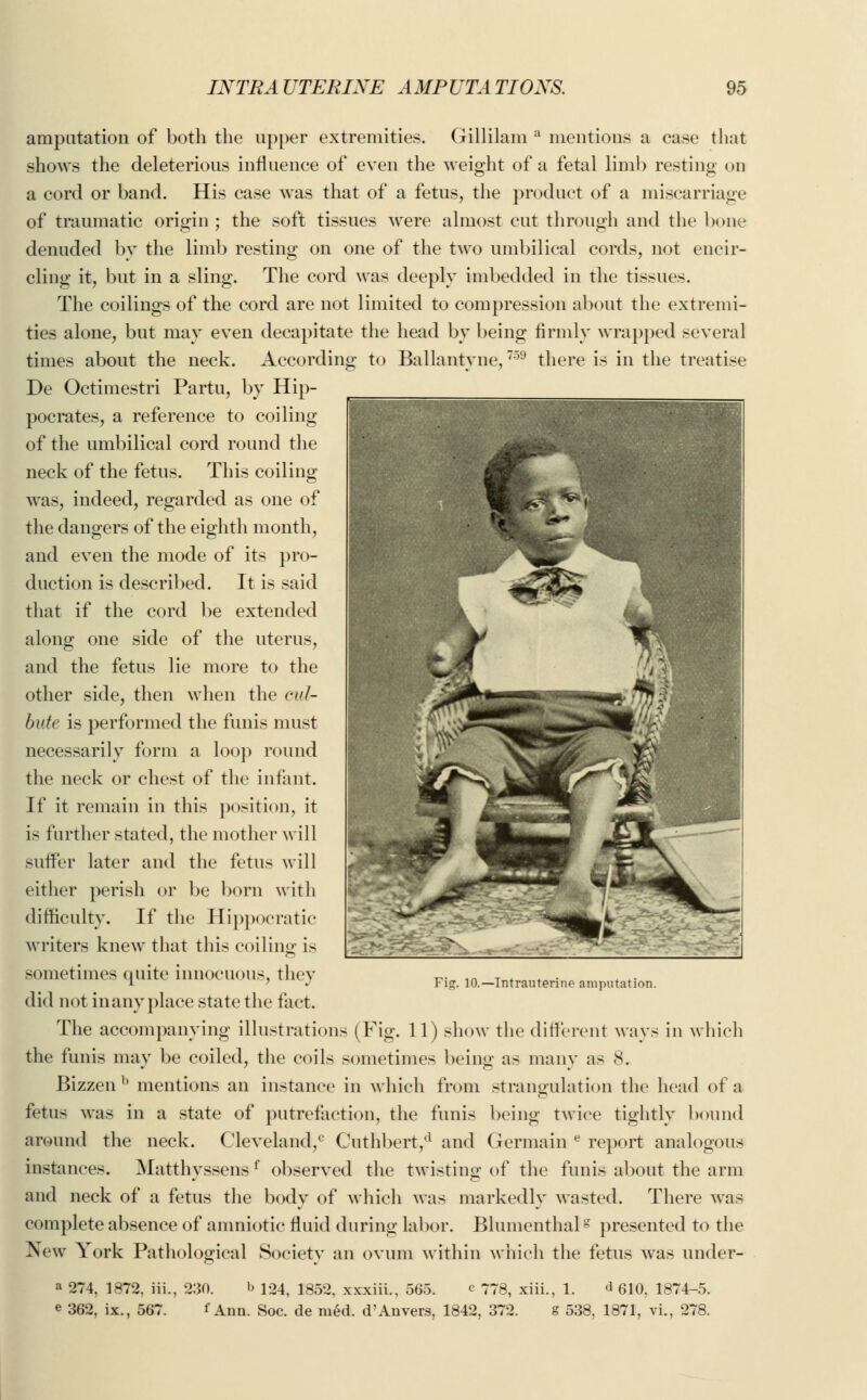 amputation of both the upper extremities. Gillilam a mentions a case that shows the deleterious influence of even the weight of a fetal limb resting on a cord or band. His case was that of a fetus, the product of a miscarriage of traumatic origin; the soft tissues were almost cut through and the bone denuded by the limb resting on one of the two umbilical cords, not encir- cling it, but in a sling. The cord was deeply imbedded in the tissues. The codings of the cord are not limited to compression about the extremi- ties alone, but may even decapitate the head by being firmly wrapped several times about the neck. According to Ballantyne,759 there is in the treatise De Octimestri Partu, by Hip- pocrates, a reference to coiling of the umbilical cord round the neck of the fetus. This coiling was, indeed, regarded as one of the dangers of the eighth month, and even the mode of its pro- duction is described. It is said that if the cord be extended along one side of the uterus, and the fetus lie more to the other side, then when the vuH- bate is performed the funis must necessarily form a loop round the neck or chest of the infant. If it remain in this position, it is further stated, the mother will suffer later and the fetus will either perish or be born with difficulty. If the Hippocratic writers knew that this coiling is sometimes quite innocuous, they did not in any place state the fact. The accompanying illustrations (Fig. 11) show the different ways in which the funis may be coiled, the coils sometimes being as many as 8. Bizzen b mentions an instance in which from strangulation the head of a fetus was in a state of putrefaction, the funis being twice tightly bound around the neck. Cleveland,0 Cuthbert/1 and Germain e report analogous instances. Matthyssensf observed the twisting of the funis about the arm and neck of a fetus the body of which was markedly wasted. There was e< >mplete absence of amniotic fluid during labor. Blumenthalg presented to the New York Pathological Society an ovum within which the fetus was under- Fig. 10.—Intrauterine amputation. a 274, 1872, Hi., 230. b 124, 1852, xxxiii., 565. c 778, xiii., 1. d 610, 1874-5. e 362, ix., 567. f Ann. Soc. de med. d'Anvers, 1842, 372. S 538, 1871, vi., 278.