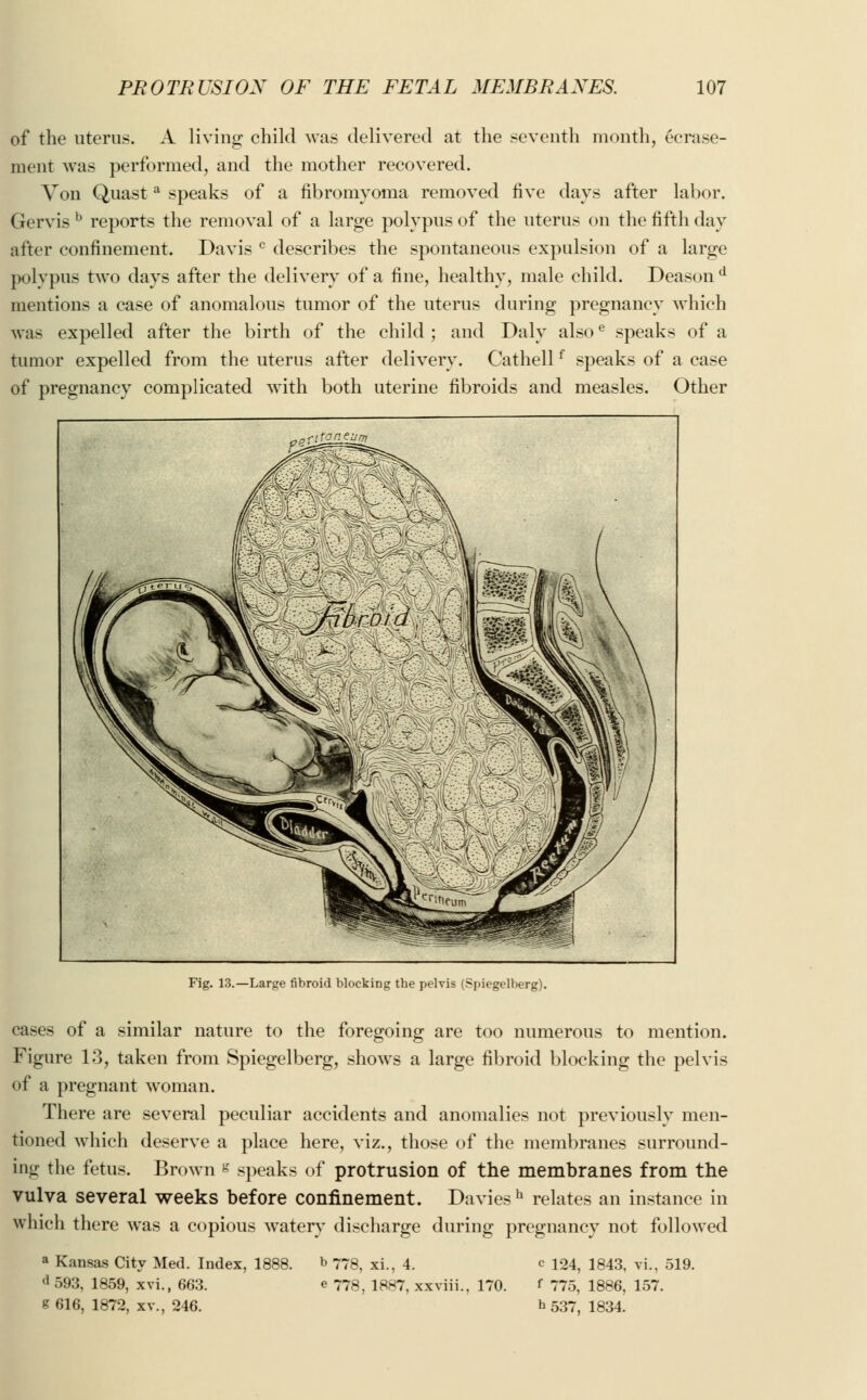 of the uterus. A living child was delivered at the seventh month, ecrase- ment was performed, and the mother recovered. Von Quasta speaks of a fibromyoma removed five days after labor. Gervis b reports the removal of a large polypus of the uterus on the fifth day after confinement. Davis c describes the spontaneous expulsion of a large polypus two days after the delivery of a fine, healthy, male child. Deason d mentions a case of anomalous tumor of the uterus during pregnancy which was expelled after the birth of the child ; and Daly alsoe speaks of a tumor expelled from the uterus after delivery. Cathellf speaks of a case of pregnancy complicated with both uterine fibroids and measles. Other Fig. 13.—Large fibroid blocking the pelvis (Spiegelberg). cases of a similar nature to the foregoing are too numerous to mention. Figure 13, taken from Spiegelberg, shows a large fibroid blocking the pelvis of a pregnant woman. There are several peculiar accidents and anomalies not previously men- tioned which deserve a place here, viz., those of the membranes surround- ing the fetus. Brown « speaks of protrusion of the membranes from the vulva several weeks before confinement. Daviesh relates an instance in which there was a copious watery discharge during pregnancy not followed a Kansas City Med. Index, 1888. d593, 1859, xvi., 663. g 616, 1872, xv., 246. b778, xi., 4. e 778, 1887, xxviii., 170. c 124, 1843, vi., 519. ' 775, 1886, 157. b 537, 1834.