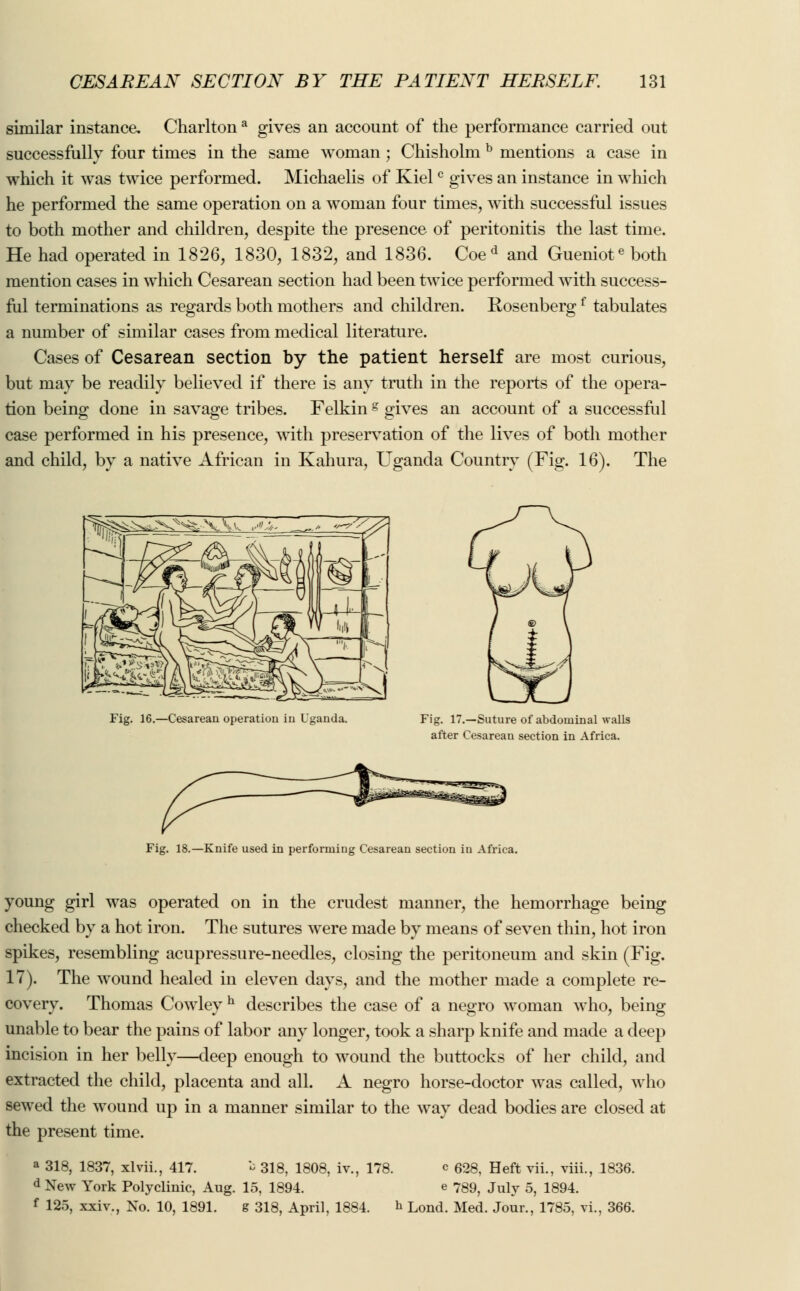 similar instance. Charltona gives an account of the performance carried out successfully four times in the same woman ; Chisholm b mentions a case in which it was twice performed. Michaelis of Kielc gives an instance in which he performed the same operation on a woman four times, with successful issues to both mother and children, despite the presence of peritonitis the last time. He had operated in 1826, 1830, 1832, and 1836. Coed and Gueniote both mention cases in which Cesarean section had been twice performed with success- ful terminations as regards both mothers and children. Rosenbergf tabulates a number of similar cases from medical literature. Cases of Cesarean section by the patient herself are most curious, but may be readily believed if there is any truth in the reports of the opera- tion being done in savage tribes. Felking gives an account of a successful case performed in his presence, with preservation of the lives of both mother and child, by a native African in Kahura, Uganda Country (Fig. 16). The Fig. 16.—Cesarean operation in Uganda. Fig. 17.—Suture of abdominal walls after Cesarean section in Africa. Fig. 18.—Knife used in performing Cesarean section in Africa. young girl was operated on in the crudest manner, the hemorrhage being checked by a hot iron. The sutures were made by means of seven thin, hot iron spikes, resembling acupressure-needles, closing the peritoneum and skin (Fig. 17). The wound healed in eleven days, and the mother made a complete re- covery. Thomas Cowley h describes the case of a negro woman who, being unable to bear the pains of labor any longer, took a sharp knife and made a deep incision in her belly—deep enough to wound the buttocks of her child, and extracted the child, placenta and all. A negro horse-doctor was called, who sewed the wound up in a manner similar to the way dead bodies are closed at the present time. a 318, 1837, xlvii., 417. * 318, 1808, iv., 178. c 628, Heft vii., viii., 1836. d New York Polyclinic, Aug. 15, 1894. e 789, July 5, 1894. f 125, xxiv., No. 10, 1891. g 318, April, 1884. & Lond. Med. Jour., 1785, vi., 366.
