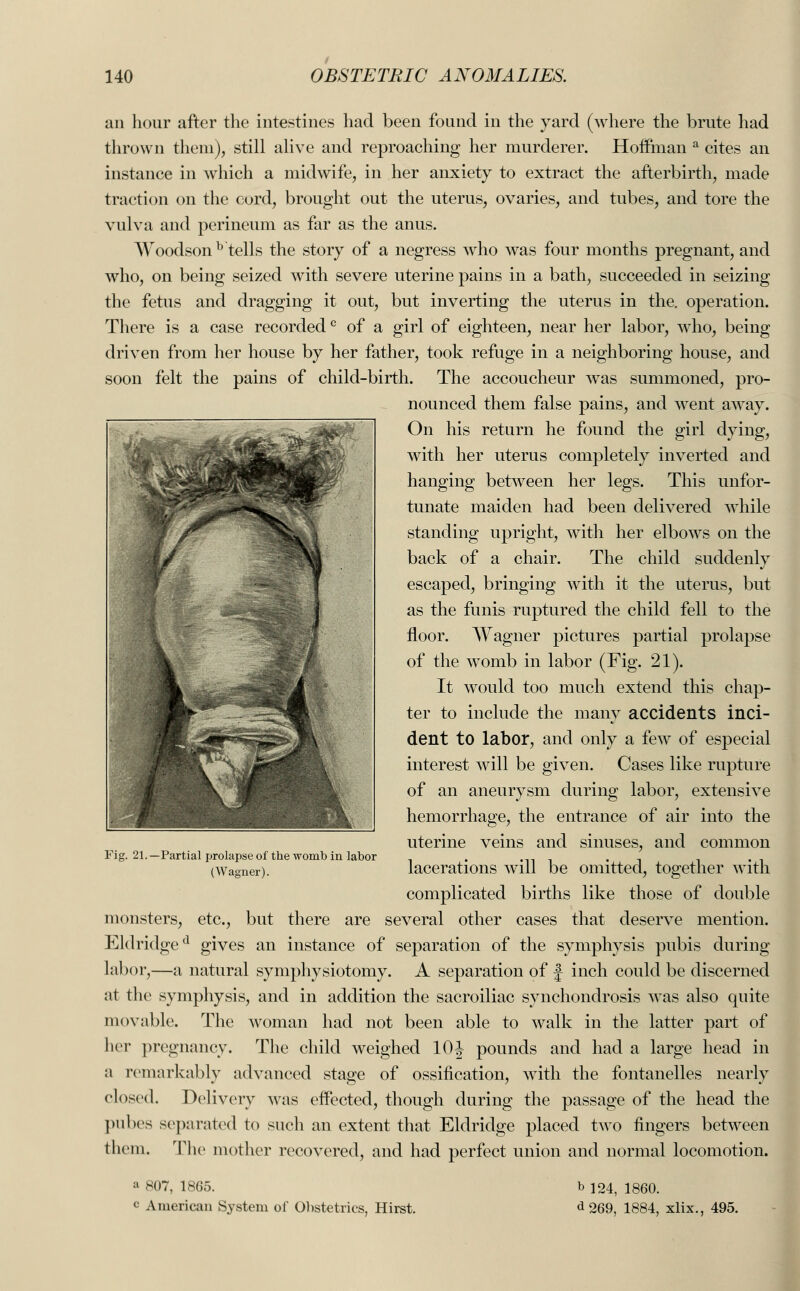 an hour after the intestines had been found in the yard (where the brute had thrown them), still alive and reproaching her murderer. Hoffman a cites an instance in which a midwife, in her anxiety to extract the afterbirth, made traction on the cord, brought out the uterus, ovaries, and tubes, and tore the vulva and perineum as far as the anus. Woodson b tells the story of a negress who was four months pregnant, and who, on being seized with severe uterine pains in a bath, succeeded in seizing the fetus and dragging it out, but inverting the uterus in the. operation. There is a case recordedc of a girl of eighteen, near her labor, who, being driven from her house by her father, took refuge in a neighboring house, and soon felt the pains of child-birth. The accoucheur was summoned, pro- nounced them false pains, and went away. On his return he found the girl dying, with her uterus completely inverted and hanging between her legs. This unfor- tunate maiden had been delivered while standing upright, with her elbows on the back of a chair. The child suddenly escaped, bringing with it the uterus, but as the funis ruptured the child fell to the floor. Wagner pictures partial prolapse of the womb in labor (Fig. 21). It would too much extend this chap- ter to include the many accidents inci- dent to labor, and only a few of especial interest will be given. Cases like rupture of an aneurysm during labor, extensive hemorrhage, the entrance of air into the uterine veins and sinuses, and common lacerations will be omitted, together with complicated births like those of double monsters, etc., but there are several other cases that deserve mention. Eld ridged gives an instance of separation of the symphysis pubis during labor,—a natural symphysiotomy. A separation of f inch could be discerned at the symphysis, and in addition the sacroiliac synchondrosis was also quite movable. The woman had not been able to walk in the latter part of her pregnancy. The child weighed 10J pounds and had a large head in a remarkably advanced stage of ossification, with the fontanelles nearly closed. Delivery was effected, though during the passage of the head the pubes separated to such an extent that Eldridge placed two fingers between them. The mother recovered, and had perfect union and normal locomotion. Fig. 21. -Partial prolapse of the womb in labor (Wagner). a 807, 1865. c American System of Obstetrics, Hirst. b 124, 1860. d 269, 1884, xlix. 495.
