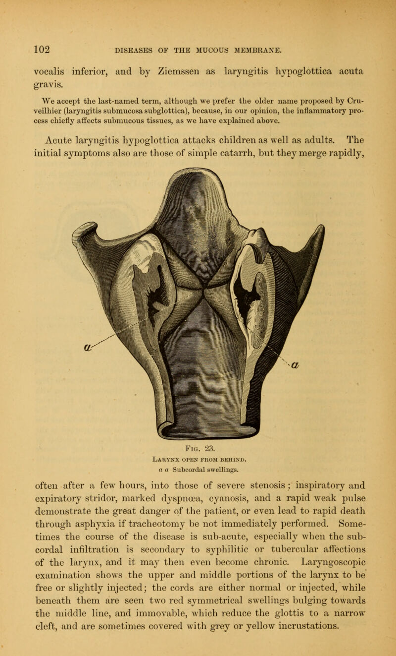 vocalis inferior, and by Ziemssen as laryngitis hypoglottica acuta gravis. We accept the last-named term, although we prefer the older name proposed by Cru- veilhier (laryngitis submucosa subglottica), because, in our opinion, the inflammatory pro- cess chiefly affects submucous tissues, as we have explained above. Acute laryngitis hypoglottica attacks children as well as adults. The initial symptoms also are those of simple catarrh, but they merge rapidly, Fig. 23. Larynx open from behind. o o Subcordal swellings. often after a few hours, into those of severe stenosis ; inspiratory and expiratory stridor, marked dyspnoea, cyanosis, and a rapid weak pulse demonstrate the great danger of the patient, or even lead to rapid death through asphyxia if tracheotomy be not immediately performed. Some- times the course of the disease is sub-acute, especially when the sub- cordal infiltration is secondary to syphilitic or tubercular affections of the laiynx, and it may then even become chronic. Laryngoscopic examination shows the upper and middle portions of the larynx to be free or slightly injected; the cords are either normal or injected, while beneath them are seen two red symmetrical swellings bulging towards the middle line, and immovable, which reduce the glottis to a narrow cleft, and are sometimes covered with grey or yellow incrustations.
