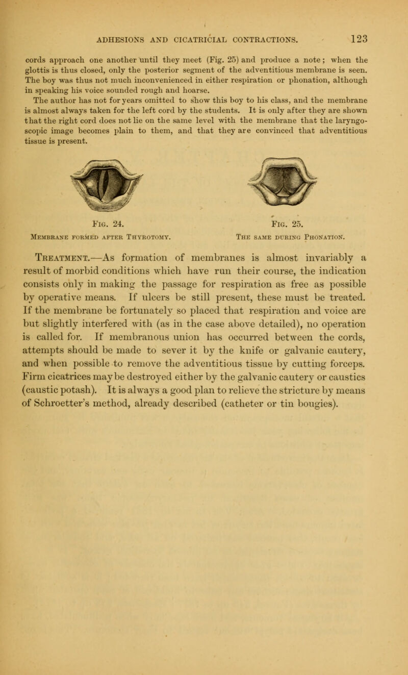 cords approach one another until they meet (Fig. 25) and produce a note; when the glottis is thus closed, only the posterior segment of the adventitious membrane is seen. The boy was thus not much inconvenienced in either respiration or phonation, although in speaking his voice sounded rough and hoarse. The author has not for years omitted to show this boy to his class, and the membrane is almost always taken for the left cord by the students. It is only after they are shown that the right cord does not lie on the same level with the membrane that the laryngo- scopy image becomes plain to them, and that they are convinced that adventitious tissue is present. Fig. 24. Fig. 25. Membrane farmed after Thyrotomy. The same during Phonatiox. Treatment.—As formation of membranes is almost invariably a result of morbid conditions which have run their course, the indication consists only in making the passage for respiration as free as possible by operative means. If ulcers be still present, these must be treated. If the membrane be fortunately so placed that respiration and voice are but slightly interfered with (as in the case above detailed), no operation is called for. If membranous union has occurred between the cords, attempts should be made to sever it by the knife or galvanic cautery, and when possible to remove the adventitious tissue by cutting forceps. Firm cicatrices maybe destroyed either by the galvanic cautery or caustics (caustic potash). It is always a good plan to relieve the stricture by means of Schroetter's method, already described (catheter or tin bougies).