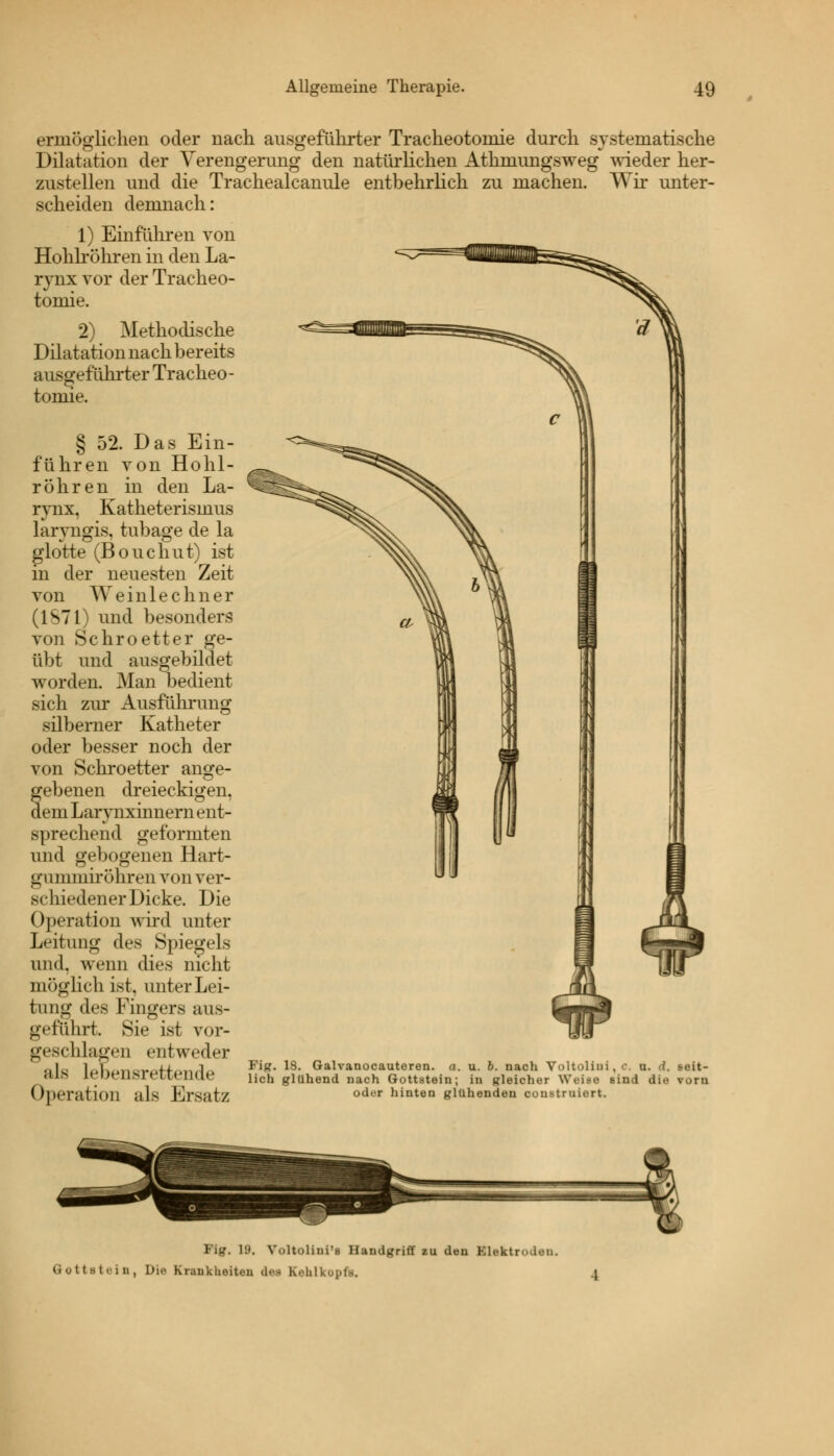 ermöglichen oder nach ausgeführter Tracheotoniie durch systematische Dilatation der Verengerung den natürlichen Athmungsweg wieder her- zustellen und die Trachealcanule entbehrlich zu machen. Wir unter- scheiden demnach: 1) Einführen von Hohlröhren in den La- rynx vor der Tracheo- toniie. 2) Methodische Dilatation nach bereits ausgeführter Tracheo - toniie. § 52. Das Ein- führen von Hohl- röhren in den La- rynx, Katheterismus laryngis, tubage de la glotte (Bouchut) ist in der neuesten Zeit von Weinle c h ne r (IST 1) und besonders von Schroetter ge- übt und ausgebildet worden. Man bedient sich zur Ausführung silberner Katheter oder besser noch der von Schroetter ange- gebenen dreieckigen, dem Larynxinnern ent- sprechend geformten und gebogenen Hart- gummiröhren von ver- schiedener Dicke. Die Operation wird unter Leitung des Spiegels und, wenn dies nicht möglich ist. unter Lei- tung des Fingers aus- geführt Sie ist vor- geschlafen entweder als lebensrettende Operation als Ersatz Fig. 18. Galvanocauteren. a. u. 6. nach Voltolini.c. u. d. seit- lich glühend nach Gottstein; in gleicher Weise sind die vorn oder hinten glühenden construiert. Fig. 19. Voltoliui'8 Handgriff zu den Elektroden. Gtottetein, Di« Kreakaeiteii dei Eehlki |