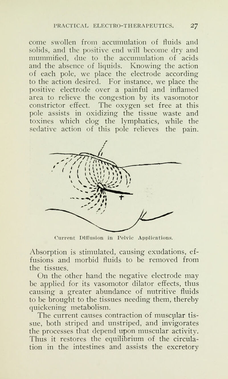 come swollen from accumulation of fluids and solids, and the positive end will become dry and mummified, due to the accumulation of acids and the absence of liquids. Knowing the action of each pole, we place the electrode according to the action desired. For instance, we place the positive electrode over a painful and inflamed area to relieve the congestion by its vasomotor constrictor effect. The oxygen set free at this pole assists in oxidizing the tissue waste and toxines which clog the lymphatics, while the sedative action of this pole relieves the pain. ' ' \ \\V, ' 1 « 1 Current Diffusion in Pelvic Applications. /Absorption is stimulated, causing exudations, ef- fusions and morbid fluids to be removed from the tissues. On the other hand the negative electrode may be applied for its vasomotor dilator effects, thus causing a greater abundance of nutritive fluids to be brought to the tissues needing them, thereby quickening metabolism. The current causes contraction of muscular tis- sue, both striped and unstriped, and invigorates the processes that depend upon muscular activity. Thus it restores the equilibrium of the circula- tion in the intestines and assists the excretory