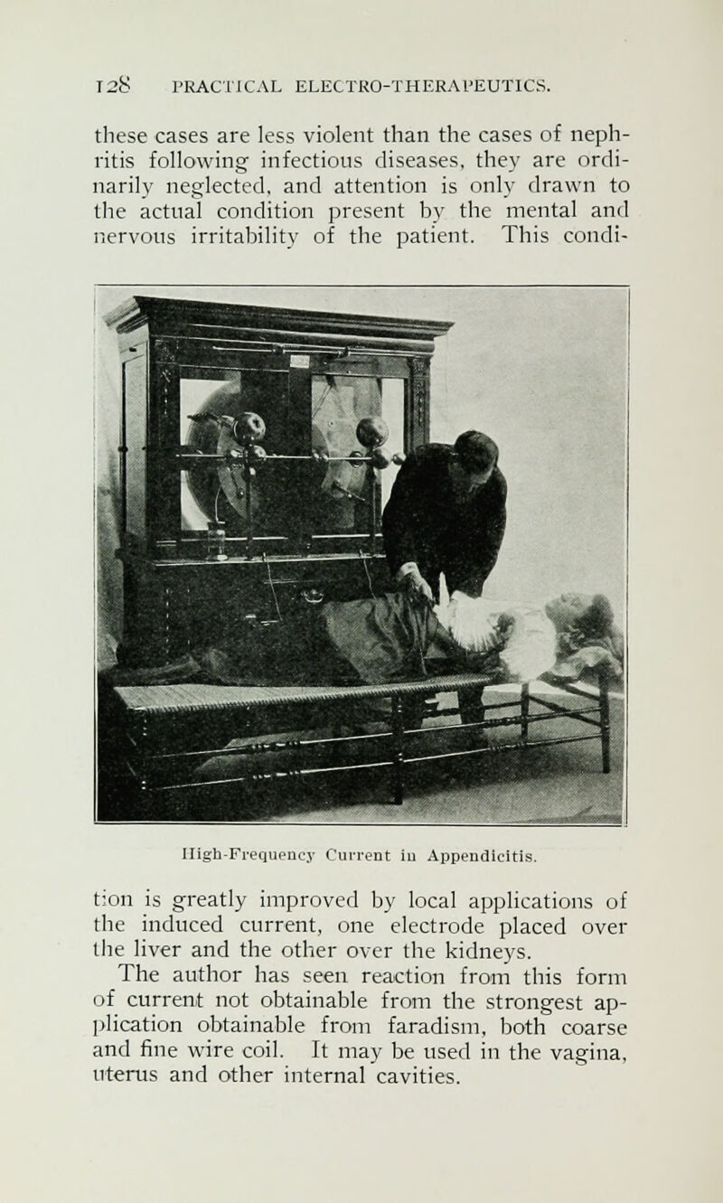these cases are less violent than the cases of neph- ritis following infectious diseases, they are ordi- narily neglected, and attention is only drawn to the actual condition present by the mental and nervous irritability of the patient. This condi- A .. Ik' \ An / .ft aft --*) HHet «A I High-Frequency Cui-rent iu Appendicitis. tion is greatly improved by local applications of the induced current, one electrode placed over the liver and the other over the kidneys. The author has seen reaction from this form of current not obtainable from the strongest ap- plication obtainable from faradism, both coarse and fine wire coil. It may be used in the vagina, uterus and other internal cavities.