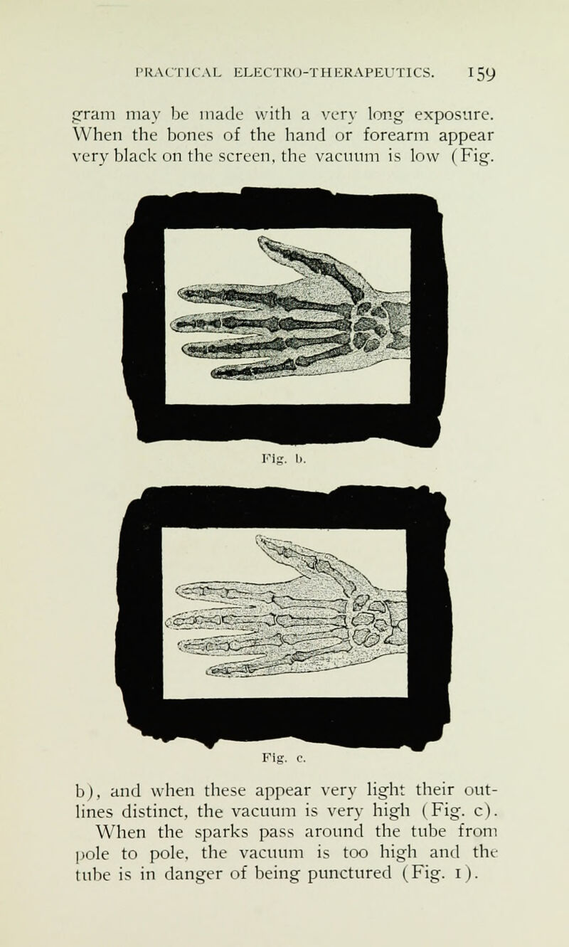 gram may be made with a very long exposure. When the bones of the hand or forearm appear very black on the screen, the vacuum is low (Fig-. Vig- b. b), and when these appear very light their out- lines distinct, the vacuum is very high (Fig. c). When the sparks pass around the tube from pole to pole, the vacuum is too high and the tube is in danger of being punctured (Fig. 1).