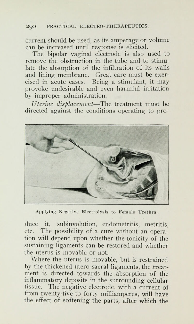 current should be used, as its amperage or volume can be increased until response is elicited. The bipolar vaginal electrode is also used to remove the obstruction in the tube and to stimu- late the absorption of the infiltration of its walls and lining membrane. Great care must be exer- cised in acute cases. Being a stimulant, it may provoke undesirable and even harmful irritation by improper administration. Uterine displacement—The treatment must be directed against the conditions operating to pro- Applying Negative Electrolysis to Female Urethra. duce it, subinvolution, endometritis, metritis, etc. The possibility of a cure without an opera- tion will depend upon whether the tonicity of the sustaining ligaments can be restored and whether the uterus is movable or not. Where the uterus is movable, but is restrained by the thickened utero-sacral ligaments, the treat- ment is directed towards the absorption of the inflammatory deposits in the surrounding cellular tissue. The negative electrode, with a current of from twenty-five to forty milliamperes, will have the effect of softening the parts, after which the