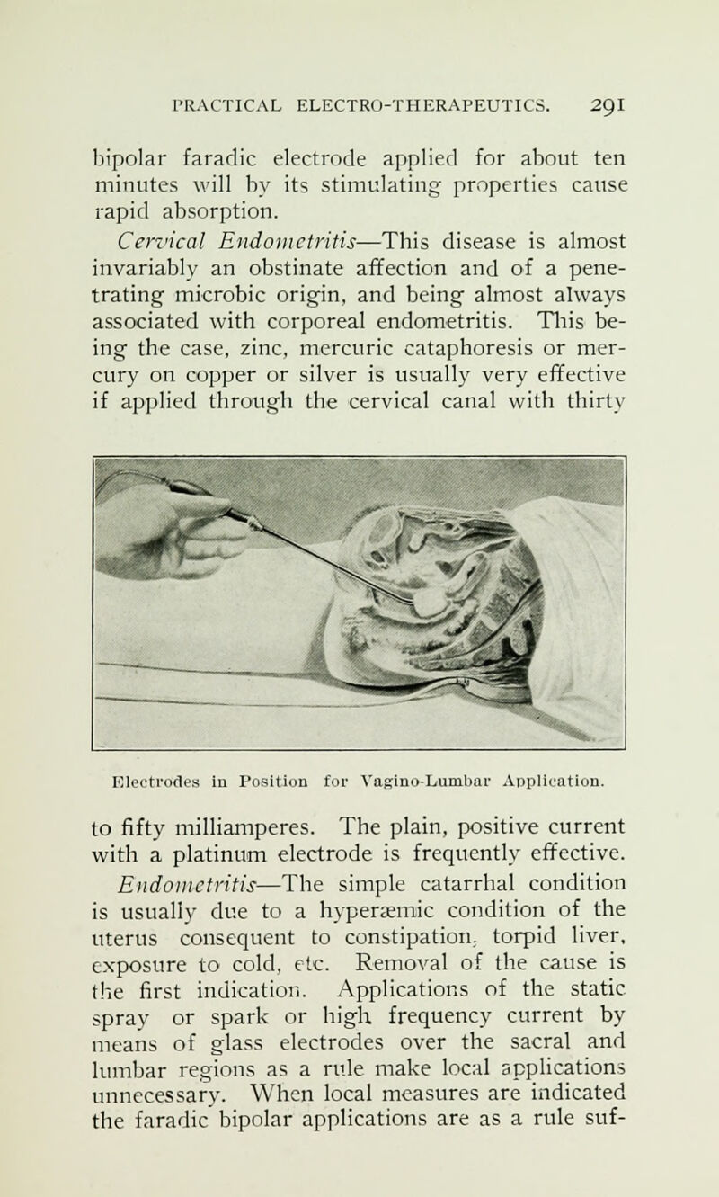 bipolar faradic electrode applied for about ten minutes will by its stimulating properties cause rapid absorption. Cervical Endometritis—This disease is almost invariably an obstinate affection and of a pene- trating microbic origin, and being almost always associated with corporeal endometritis. This be- ing the case, zinc, mercuric cataphoresis or mer- cury on copper or silver is usually very effective if applied through the cervical canal with thirty Electrodes in Position for Vagino-Lumbai- Application. to fifty milliamperes. The plain, positive current with a platinum electrode is frequently effective. Endometritis—The simple catarrhal condition is usually clue to a hyperasmic condition of the uterus consequent to constipation, torpid liver, exposure to cold, etc. Removal of the cause is the first indication. Applications of the static, spray or spark or high frequency current by means of glass electrodes over the sacral and lumbar regions as a rule make local applications unnecessary. When local measures are indicated the faradic bipolar applications are as a rule suf-