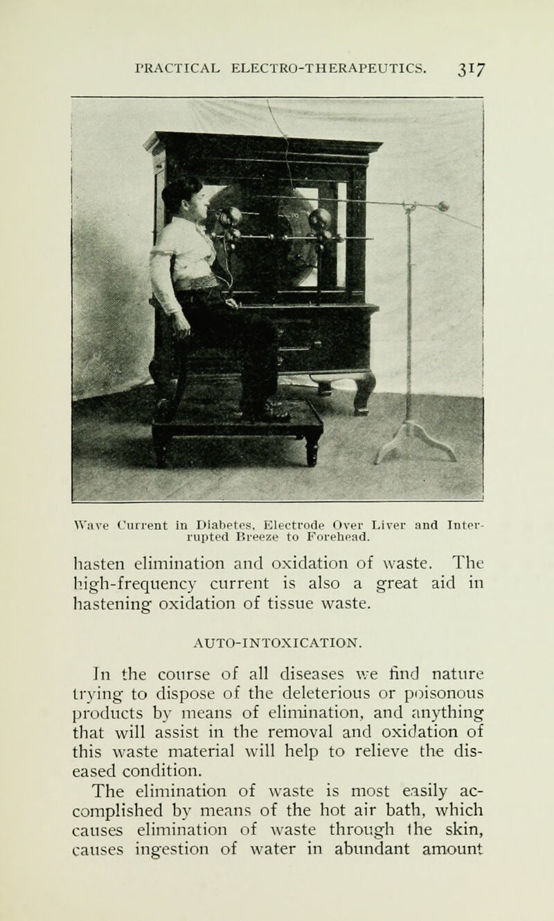 Wave Current in Diabetes, Electrode Over Liver and Inter- rupted Breeze to Forehead. hasten elimination and oxidation of waste. The high-frequency current is also a great aid in hastening oxidation of tissue waste. AUTO-INTOXICATION. In the course of all diseases we find nature trying to dispose of the deleterious or poisonous products by means of elimination, and anything that will assist in the removal and oxidation of this waste material will help to relieve the dis- eased condition. The elimination of waste is most easily ac- complished by means of the hot air bath, which causes elimination of waste through Ihe skin, causes ingestion of water in abundant amount