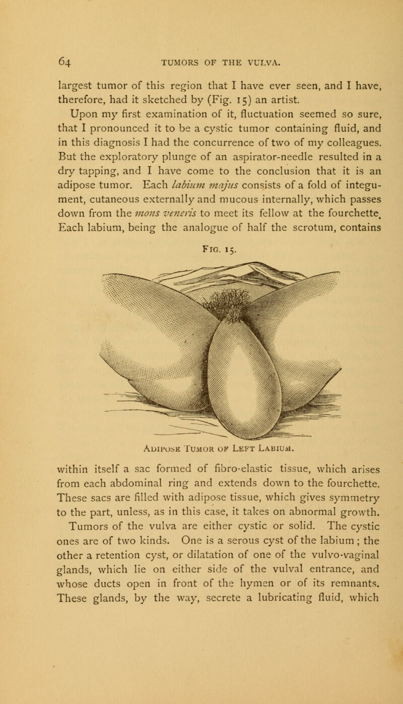 largest tumor of this region that I have ever seen, and I have, therefore, had it sketched by (Fig. 15) an artist. Upon my first examination of it, fluctuation seemed so sure, that I pronounced it to be a cystic tumor containing fluid, and in this diagnosis I had the concurrence of two of my colleagues. But the exploratory plunge of an aspirator-needle resulted in a dry tapping, and I have come to the conclusion that it is an adipose tumor. Each labium majus consists of a fold of integu- ment, cutaneous externally and mucous internally, which passes down from the mom veneris to meet its fellow at the fourchette. Each labium, being the analogue of half the scrotum, contains Fig. 15. Adipose Tumor of Left Labium. within itself a sac formed of fibro-elastic tissue, which arises from each abdominal ring and extends down to the fourchette. These sacs are filled with adipose tissue, which gives symmetry to the part, unless, as in this case, it takes on abnormal growth. Tumors of the vulva are either cystic or solid. The cystic ones are of two kinds. One is a serous cyst of the labium ; the other a retention cyst, or dilatation of one of the vulvo-vaginal glands, which lie on either side of the vulval entrance, and whose ducts open in front of the hymen or of its remnants. These glands, by the way, secrete a lubricating fluid, which