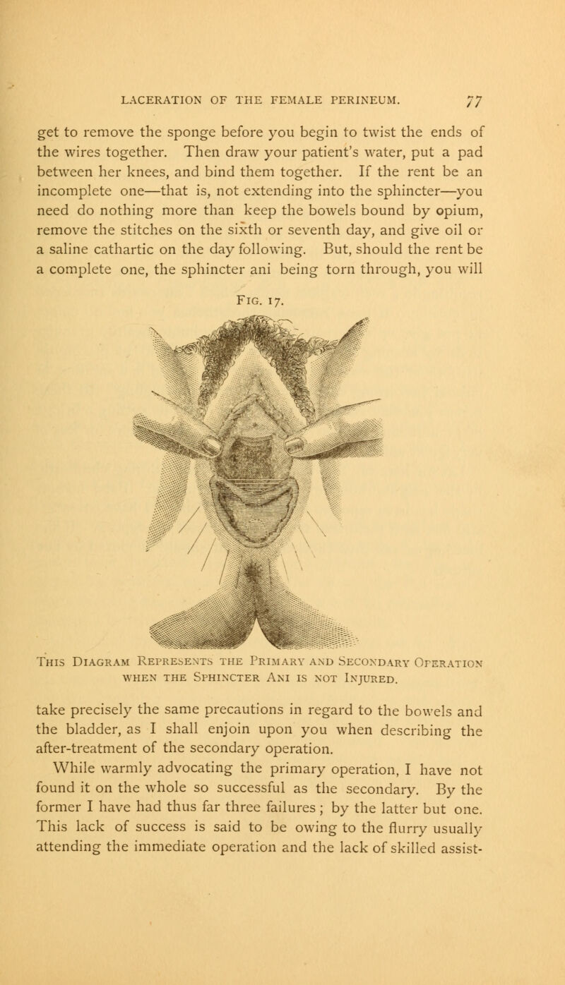 get to remove the sponge before you begin to twist the ends of the wires together. Then draw your patient's water, put a pad between her knees, and bind them together. If the rent be an incomplete one—that is, not extending into the sphincter—you need do nothing more than keep the bowels bound by opium, remove the stitches on the sixth or seventh day, and give oil or a saline cathartic on the day following. But, should the rent be a complete one, the sphincter ani being torn through, you will Fig. 17. This Diagram Represents the Primary and Secondary Operation when the Sphincter Ani is not Injured. take precisely the same precautions in regard to the bowels and the bladder, as I shall enjoin upon you when describing the after-treatment of the secondary operation. While warmly advocating the primary operation, I have not found it on the whole so successful as the secondary. By the former I have had thus far three failures; by the latter but one. This lack of success is said to be owing to the flurry usually attending the immediate operation and the lack of skilled assist-