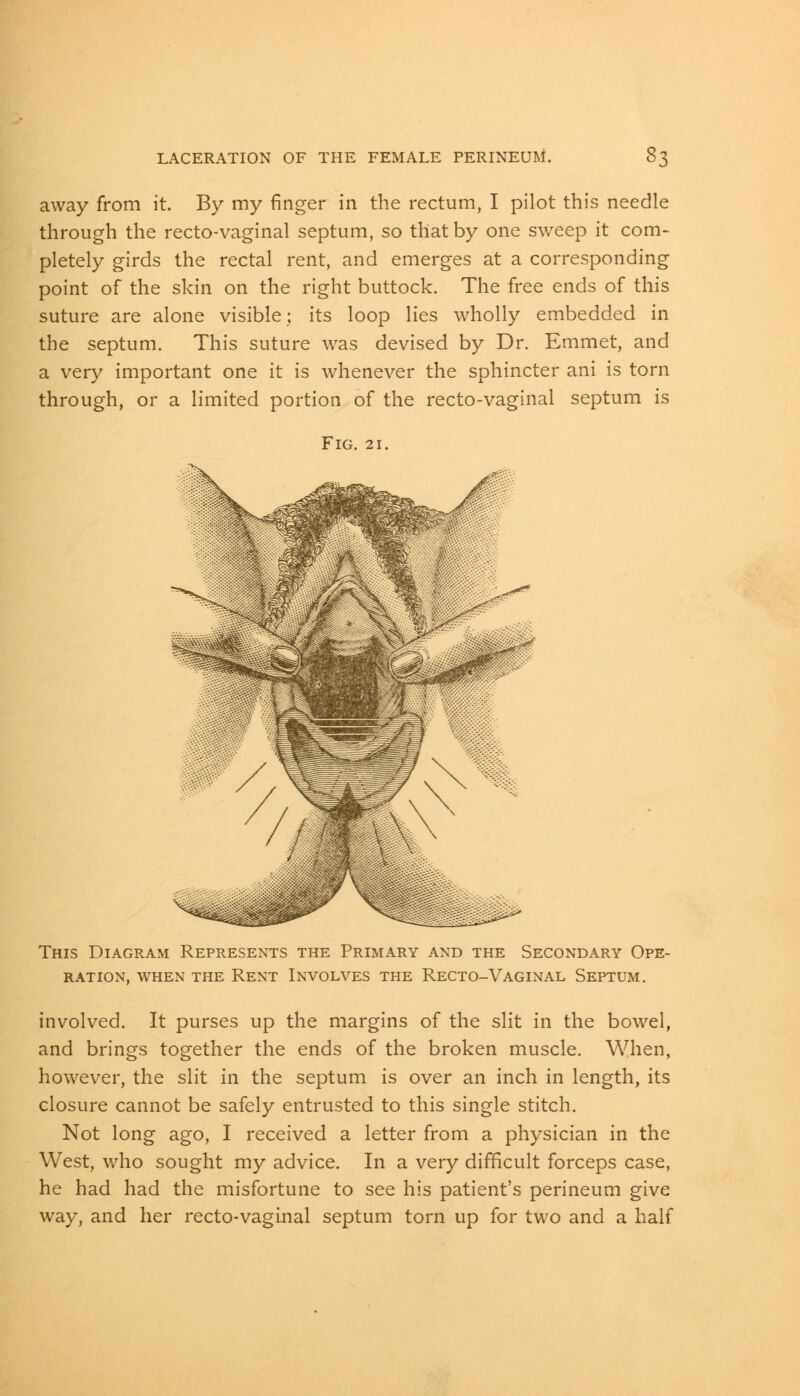away from it. By my finger in the rectum, I pilot this needle through the recto-vaginal septum, so that by one sweep it com- pletely girds the rectal rent, and emerges at a corresponding point of the skin on the right buttock. The free ends of this suture are alone visible; its loop lies wholly embedded in the septum. This suture was devised by Dr. Emmet, and a very important one it is whenever the sphincter ani is torn through, or a limited portion of the recto-vaginal septum is Fig. 21. This Diagram Represents the Primary and the Secondary Ope- ration, when the Rent Involves the Recto-Vaginal Septum. involved. It purses up the margins of the slit in the bowel, and brings together the ends of the broken muscle. When, however, the slit in the septum is over an inch in length, its closure cannot be safely entrusted to this single stitch. Not long ago, I received a letter from a physician in the West, who sought my advice. In a very difficult forceps case, he had had the misfortune to see his patient's perineum give way, and her recto-vaginal septum torn up for two and a half