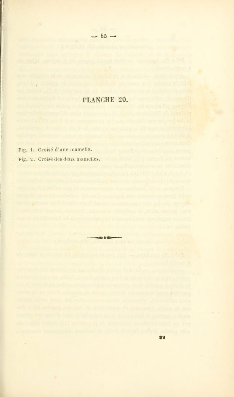 PLANCHE 20. Fis. I • Croisé d'une mamelle. Fig. 2. Croisé des deux mamelles.