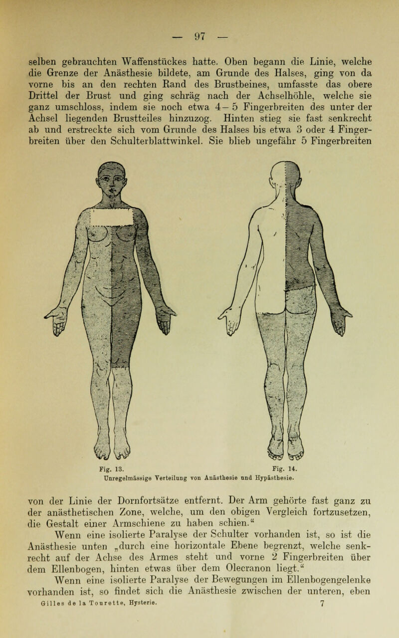 selben gebrauchten Waffenstückes hatte. Oben begann die Linie, welche die Grenze der Anästhesie bildete, am Grunde des Halses, ging von da vorne bis an den rechten Kand des Brustbeines, umfasste das obere Drittel der Brust und ging schräg nach der Achselhöhle, welche sie ganz umschloss, indem sie noch etwa 4—5 Fingerbreiten des unter der Achsel liegenden Brustteiles hinzuzog. Hinten stieg sie fast senkrecht ab und erstreckte sich vom Grunde des Halses bis etwa 3 oder 4 Finger- breiten über den Schulterblattwinkel. Sie blieb ungefähr 5 Fingerbreiten Fig. 13. Fig. 14. Unregelmässige Verteilung von Anästhesie ond Hypästhesie. von der Linie der Dornfortsätze entfernt. Der Arm gehörte fast ganz zu der anästhetischen Zone, welche, um den obigen Vergleich fortzusetzen, die Gestalt einer Armschiene zu haben schien. Wenn eine isolierte Paralyse der Schulter vorhanden ist, so ist die Anästhesie unten „durch eine horizontale Ebene begrenzt, welche senk- recht auf der Achse des Armes steht und vorne 2 Fingerbreiten über dem Ellenbogen, hinten etwas über dem Olecranon liegt. Wenn eine isolierte Paralyse der Bewegungen im Ellenbogengelenke vorhanden ist, so findet sich die Anästhesie zwischen der unteren, eben Gilles de U Tourette, Hysterie. 7