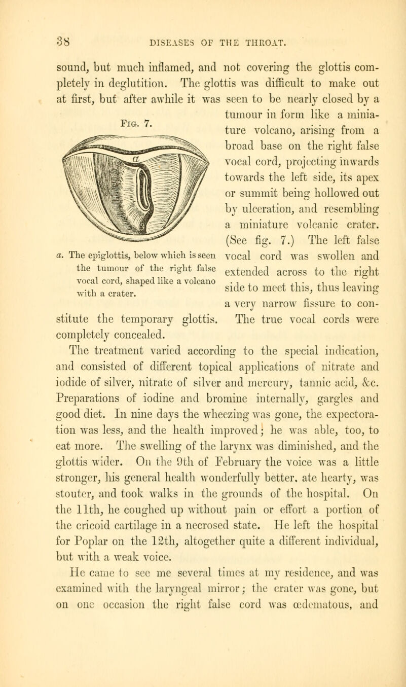 Fig. 7. sound, but much inflamed, and not covering the glottis com- pletely in deglutition. The glottis was difficult to make out at first, but after awhile it was seen to be nearly closed by a tumour in form like a minia- ture volcano, arising from a broad base on the right false vocal cord, projecting inwards towards the left side, its apex or summit being hollowed out by ulceration, and resembling a miniature volcanic crater. (See fig. 7.) The left false vocal cord was swollen and extended across to the right side to meet this, thus leaving a very narrow fissure to con- The true vocal cords were The epiglottis, below which is seen the tumour of the right false vocal cord, shaped like a volcano with a crater. stitute the temporary glottic completely concealed. The treatment varied according to the special indication, and consisted of different topical applications of nitrate and iodide of silver, nitrate of silver and mercury, tannic acid, &c. Preparations of iodine and bromine internally, gargles and good diet. In nine days the wheezing was gone, the expectora- tion was less, and the health improved; he was able, too, to eat more. The swelling of the larynx was diminished, and the glottis wider. On the 9th of February the voice was a little stronger, his general health wonderfully better, ate hearty, was stouter, and took walks in the grounds of the hospital. On the 11th, he coughed up without pain or effort a portion of the cricoid cartilage in a necrosed state. He left the hospital for Poplar on the 12th, altogether quite a different individual, but with a weak voice. He came to see me several times at my residence, and was examined with the laryngeal mirror; the crater was gone, but on one occasion the right false cord was (Edematous, and