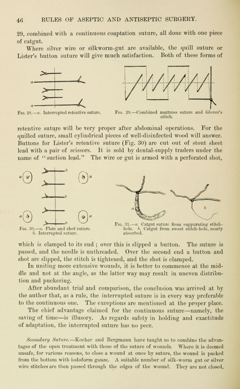 29, combined with a continuous coaptation suture, all done with one piece of catgut. Where silver wire or silkworm-gut are available, the quill suture or Lister's button suture will give much satisfaction. Both of these forms of Pa— -^ Fig. 28.—a. Interrupted retentive suture. Fio. 29.—Combined mattress suture and Glover's stitch. retentive suture will be very proper after abdominal operations. For the quilled suture, small cylindrical pieces of well-disinfected wood will answer. Buttons for Lister's retentive suture (Fig. 30) are cut out of stout sheet lead with a pair of scissors. It is sold by dental-supply traders under the name of suction lead. The wire or gut is armed with a perforated shot, 3' (o)a Fig. 30.—a. Plate and shot suture. b. Interrupted suture. Fig. 31.—a. Catgut suture from suppurating stitch- hole, b. Catgut from sweet stitch-hole, nearly absorbed. which is clamped to its end ; over this is slipped a button. The suture is passed, and the needle is unthreaded. Over the second end a button and shot are slipped, the stitch is tightened, and the shot is clamped. In uniting more extensive wounds, it is better to commence at the mid- dle and not at the angle, as the latter way may result in uneven distribu- tion and puckering. After abundant trial and comparison, the conclusion was arrived at by the author that, as a rule, the interrupted suture is in every way preferable to the continuous one. The exceptions are mentioned at the proper place. The chief advantage claimed for the continuous suture—namely, the saving of time—is illusory. As regards safety in holding and exactitude of adaptation, the interrupted suture has no peer. Secondary Suture.—Kocher and Bergtuann have taught us to combine the advan- tages of the open treatment with those of the suture of wounds. Where it is deemed unsafe, for various reasons, to close a wound at once by suture, the wound is packed from the bottom with iodoform gauze. A suitable number of silk-worm gut or silver wire stitches are then passed through the edges of the wound. They are not closed,