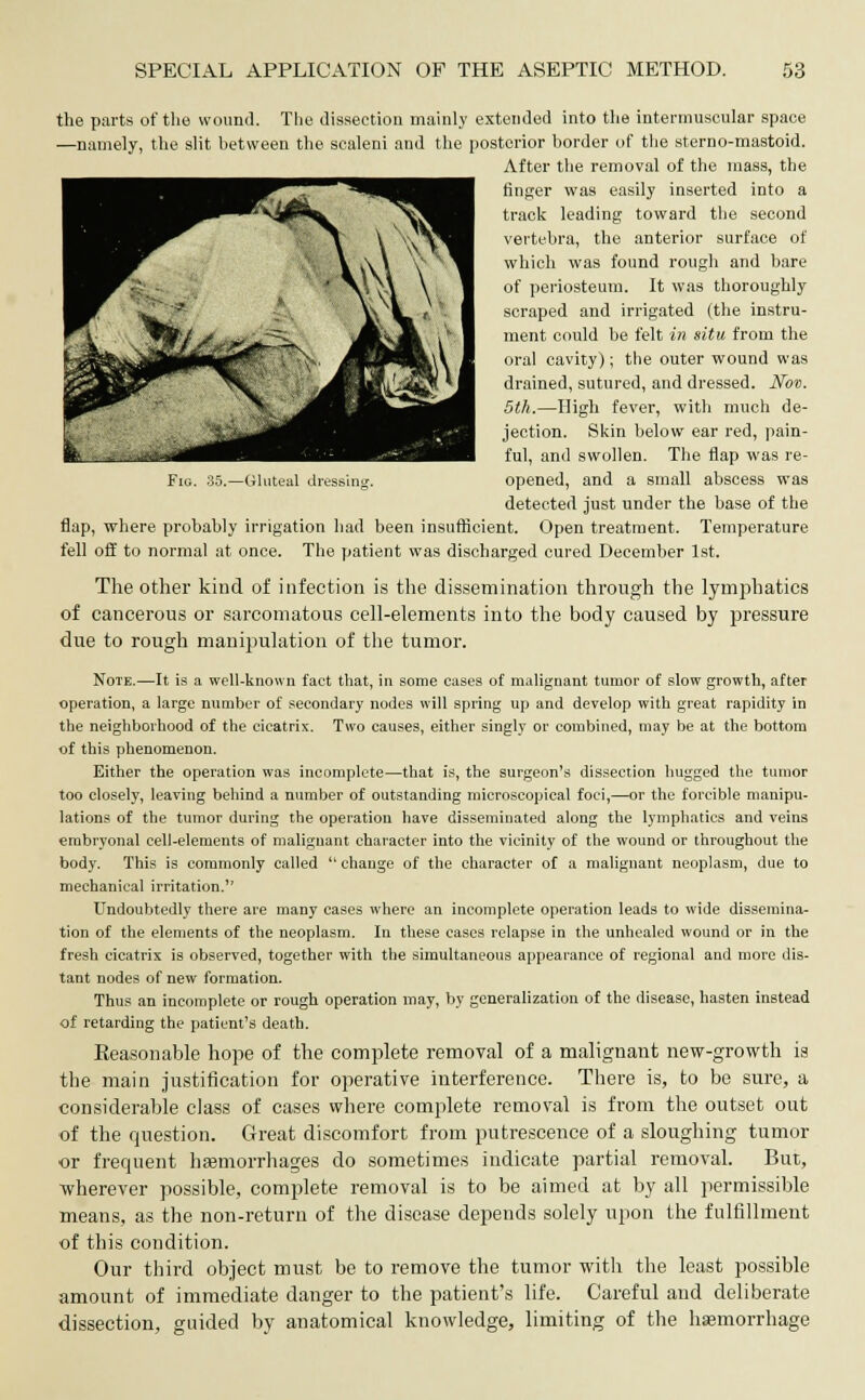 HP<i AA JsW Hy SPECIAL APPLICATION OF THE ASEPTIC METHOD. 53 the parts of the wound. The dissection mainly extended into the intermuscular space —namely, the slit hetvveen the scaleni and the posterior horder of the sterno-mastoid. After the removal of the mass, the finger was easily inserted into a track leading toward the second vertebra, the anterior surface of which was found rough and bare of periosteum. It was thoroughly scraped and irrigated (the instru- ment could be felt in situ from the oral cavity); the outer wound was drained, sutured, and dressed. Nov. 5th.—High fever, with much de- jection. Skin below ear red, pain- ful, and swollen. The flap was re- Fio. 35.—Gluteal dressing. opened, and a small abscess was detected just under the base of the flap, where probably irrigation had been insufficient. Open treatment. Temperature fell off to normal at once. The patient was discharged cured December 1st. The other kind of infection is the dissemination through the lymphatics of cancerous or sarcomatous cell-elements into the body caused by pressure due to rough manipulation of the tumor. Note.—It is a well-known fact that, in some cases of malignant tumor of slow growth, after operation, a large number of secondary nodes will spring up and develop with great rapidity in the neighborhood of the cicatrix. Two causes, either singly or combined, may be at the bottom of this phenomenon. Either the operation was incomplete—that is, the surgeon's dissection hugged the tumor too closely, leaving behind a number of outstanding microscopical foci,—or the forcible manipu- lations of the tumor during the operation have disseminated along the lymphatics and veins embryonal cell-elements of malignant character into the vicinity of the wound or throughout the body. This is commonly called  change of the character of a malignant neoplasm, due to mechanical irritation. Undoubtedly there are many cases where an incomplete operation leads to wide dissemina- tion of the elements of the neoplasm. In these cases relapse in the unhealed wound or in the fresh cicatrix is observed, together with the simultaneous appearance of regional and more dis- tant nodes of new formation. Thus an incomplete or rough operation may, by generalization of the disease, hasten instead of retarding the patient's death. Reasonable hope of the complete removal of a malignant new-growth is the main justification for operative interference. There is, to be sure, a considerable class of cases where complete removal is from the outset out of the question. Great discomfort from putrescence of a sloughing tumor or frequent haemorrhages do sometimes indicate partial removal. But, wherever possible, complete removal is to be aimed at by all permissible means, as the non-return of the disease depends solely upon the fulfillment of this condition. Our third object must be to remove the tumor with the least possible amount of immediate danger to the patient's life. Careful and deliberate dissection, guided by anatomical knowledge, limiting of the haemorrhage