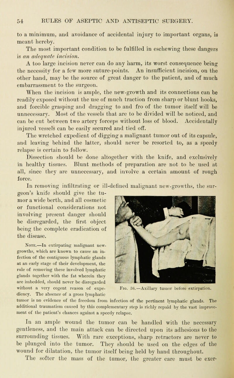 to a minimum, and avoidance of accidental injury to important organs, is meant hereby. The most important condition to be fulfilled in eschewing these dangers is an adequate incision. A too large incision never can do any harm, its worst consequence being the necessity for a few more suture-points. An insufficient incision, on the other hand, may be the source of great danger to the patient, and of much embarrassment to the surgeon. When the incision is ample, the new-growth and its connections can be readily exposed without the use of much traction from sharp or blunt hooks, and forcible grasping and dragging to and fro of the tumor itself will be unnecessary. Most of the vessels that are to be divided will be noticed, and can be cut between two artery forceps without loss of blood. Accidentally injured vessels can be easily secured and tied off. The wretched expedient of digging a malignant tumor out of its capsule, and leaving behind the latter, should never be resorted to, as a speedy relapse is certain to follow. Dissection should be done altogether with the knife, and exclusively in healthy tissues. Blunt methods of preparation are not to be used at all, since they are unnecessary, and involve a certain amount of rough force. In removing infiltrating or ill-defined malignant new-growths, the sur- geon's knife should give the tu- mor a wide berth, and all cosmetic or functional considerations not involving jiresent danger should be disregarded, the first object being the complete eradication of the disease. Note.—In extirpating malignant new- growths, which are known to cause an in- fection of the contiguous lymphatic glands at an early stage of their development, the rule of removing these involved lymphatic glands together with the fat wherein they are imbedded, should never be disregarded diency. The absence of a gross lymphatic tumor is no evidence of the freedom from infection of the pertinent lymphatic glands. The additional traumatism caused by this complementary step is richly repaid by the vast improve- ment of the patient's chances against a speedy relapse. In an ample wound the tumor can be handled with the necessary gentleness, and the main attack can be directed upon its adhesions to the surrounding tissues. With rare exceptions, sharp retractors are never to be plunged into the tumor. They should be used on the edges of the wound for dilatation, the tumor itself being held by hand throughout. The softer the mass of the tumor, the greater care must be exer-