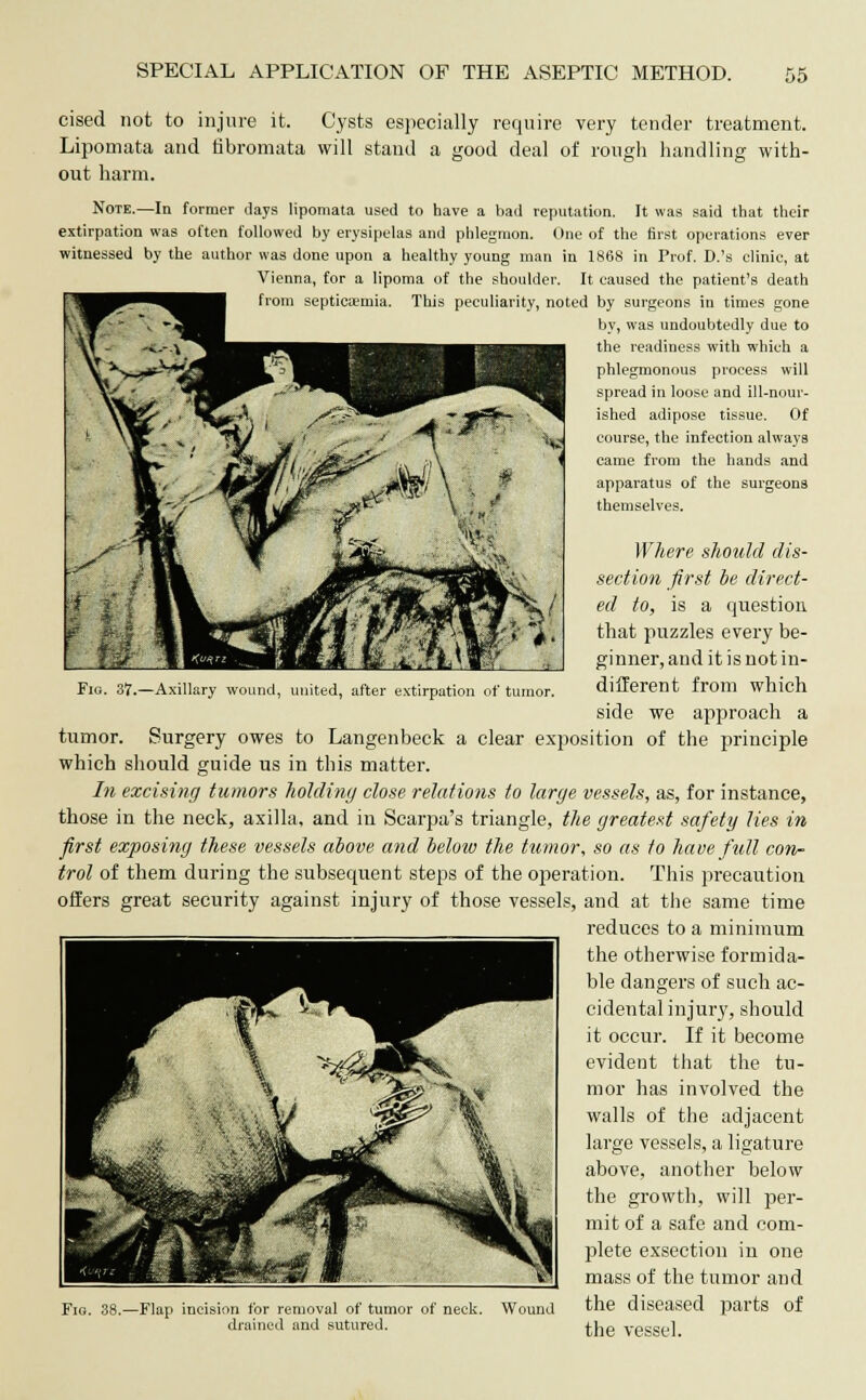 Fig. 37.—Axillary wound, united, after extirpation of tumor. cised not to injure it. Cysts especially require very tender treatment. Lipomata and fibromata will stand a good deal of rough handling with- out harm. Note.—In former days lipomata used to have a bad reputation. It was said that their extirpation was often followed by erysipelas and phlegmon. One of the first operations ever witnessed by the author was done upon a healthy young man in 1868 in Prof. D.'s clinic, at Vienna, for a lipoma of the shoulder. It caused the patient's death from septicaemia. This peculiarity, noted by surgeons in times gone by, was undoubtedly due to the readiness with which a phlegmonous process will spread in loose and ill-nour- ished adipose tissue. Of course, the infection always came from the hands and apparatus of the surgeons themselves. Where should dis- section first be direct- ed to, is a question that puzzles every be- ginner, and it is not in- different from which side we approach a tumor. Surgery owes to Langenbeck a clear exposition of the principle which should guide us in this matter. In excising tumors holding close relations to large vessels, as, for instance, those in the neck, axilla, and in Scarpa's triangle, the greatest safety lies in first exposing these vessels above and below the tumor, so as to have full con- trol of them during the subsequent steps of the operation. This precaution offers great security against injury of those vessels, and at the same time reduces to a minimum the otherwise formida- ble dangers of such ac- cidental injury, should it occur. If it become evident that the tu- mor has involved the walls of the adjacent large vessels, a ligature above, another below the growth, will per- mit of a safe and com- plete exsection in one mass of the tumor and Wound the diseased parts of the vessel. Fig. 38.—Flap incision for removal of tumor of neck drained and sutured.