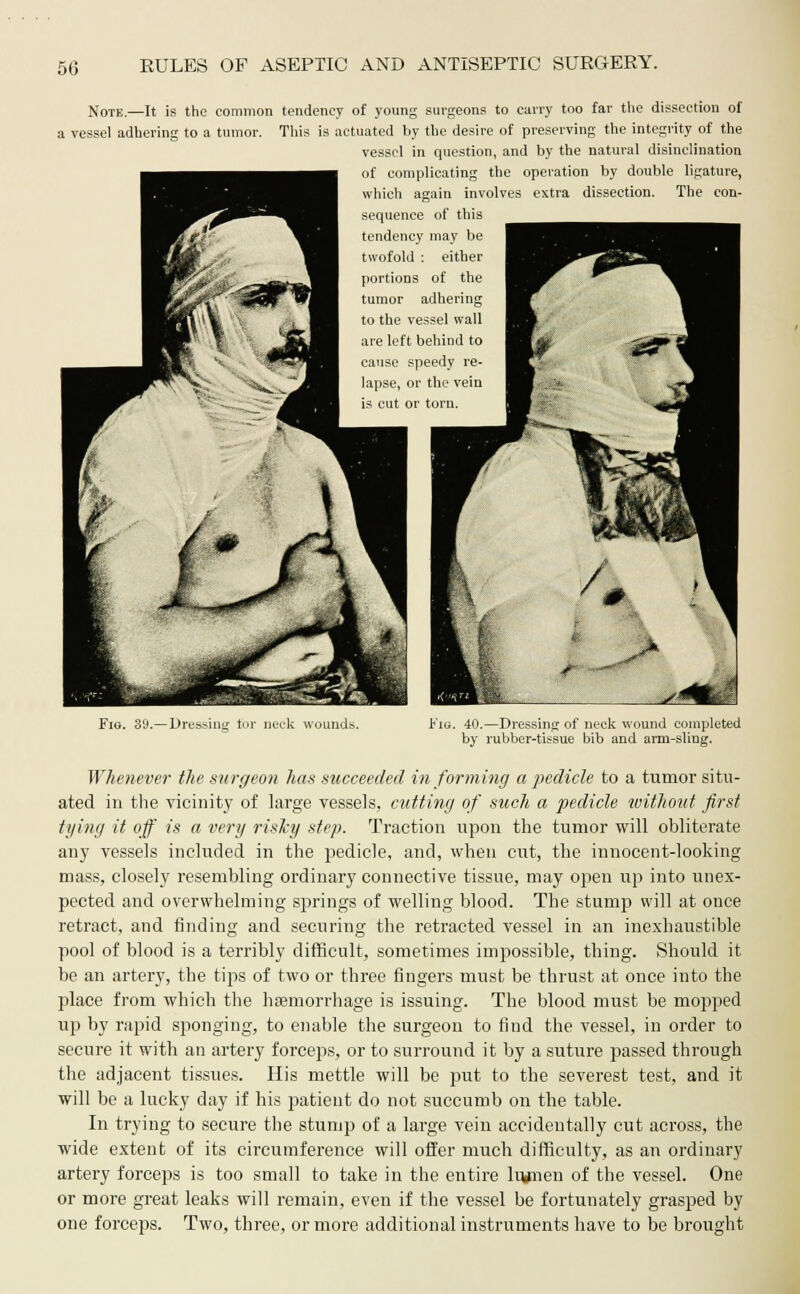 50 Note.—It is the common tendency of young surgeons to curry too far the dissection of a vessel adhering to a tumor. This is actuated by the desire of preserving the integrity of the vessel in question, and by the natural disinclination of complicating the operation by double ligature, which again involves extra dissection. The con- sequence of this tendency may be twofold : either portions of the tumor adhering to the vessel wall are left behind to cause speedy re- lapse, or the vein is cut or torn. Fig. 89.—Dressing tor neck wound.-,. Fig. 40.—Dressing of neck wound completed by rubber-tissue bib and arm-sling. Whenever the surgeon has succeeded in forming a pedicle to a tumor situ- ated in the vicinity of large vessels, cutting of such a pedicle without first tying it off is a very risky step. Traction upon the tumor will obliterate any vessels included in the pedicle, and, when cut, the innocent-looking mass, closely resembling ordinary connective tissue, may open up into unex- pected and overwhelming springs of welling blood. The stump will at once retract, and finding and securing the retracted vessel in an inexhaustible pool of blood is a terribly difficult, sometimes impossible, thing. Should it be an artery, the tips of two or three fingers must be thrust at once into the place from which the haemorrhage is issuing. The blood must be mopped up by rapid sponging, to enable the surgeon to find the vessel, in order to secure it with an artery forceps, or to surround it by a suture passed through the adjacent tissues. His mettle will be put to the severest test, and it will be a lucky day if his patient do not succumb on the table. In trying to secure the stump of a large vein accidentally cut across, the wide extent of its circumference will offer much difficulty, as an ordinary artery forceps is too small to take in the entire lujnen of the vessel. One or more great leaks will remain, even if the vessel be fortunately grasped by one forceps. Two, three, or more additional instruments have to be brought