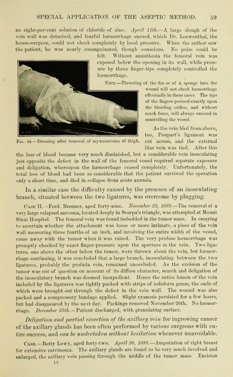 an eight-per-cent solution of chloride of zinc. April 11th.—A large slough of the vein wall was detached, and fearful haemorrhage ensued, which Dr. Loewenthal, the house-surgeon, could not check completely by local pressure. When the author saw the patient, he was nearly exsanguinated, though conscious. No pulse could be felt. Without anaesthesia the femoral vein was exposed below the opening in its wall, while press- ure by three finger-tips completely controlled the usting of the fist or of a sponge into the wound will not check haemorrhage effectually in these cases. The tips of the fingers pressed exactly upon the bleeding orifice, and without much force, will always succeed in controlling the vessel. Fig. 44.—Dressing after removal of myxosarcoma of thigh. As the vein bled from above, too, Poupart's ligament was cut across, and the external iliac vein was tied. After this the loss of blood became very much diminished, but a considerable vein inosculating just opposite the defect in the wall of the femoral vessel required separate exposure and deligation, whereupon the haemorrhage ceased completely. Unfortunately, the total loss of blood had been so considerable that the patient survived the operation only a short time, and died in collapse from acute anosmia. In a similar case the difficulty caused by the presence of an inosculating branch, situated between the two ligatures, was overcome by plugging. Case II. —Ferd. Brenner, aged forty-nine. November 22, 1889.—The removal of a very large relapsed sarcoma, located deeply in Scarpa's triangle, was attempted at Mount Sinai Hospital. The femoral vein was found imbedded in the tumor mass. In essaying to ascertain whether the attachment was loose or more intimate, a piece of the vein wall measuring three fourths of an inch, and involving the entire width of the vessel, came away with the tumor when it was raised. The very profuse breinorrhage was promptly checked by exact finger-pressure upon the aperture in the vein. Two liga- tures, one above the other below the tumor, were thrown about the vein, but hasmor- rhage continuing, it was concluded that a large branch, inosculating between the two ligatures, probably the profuda vein, remained unoccluded. As the excision of the tumor was out of question on account of its diffuse character, search and deligation of the inosculatory branch was deemed inexpedient. Hence the entire lumen of the vein included by the ligatures was tightly packed with strips of iodoform gauze, the ends of which were brought out through the defect in the vein wall. The wound was also packed and a compressory bandage applied. Slight cyanosis persisted for a few hours, but had disappeared by the next day. Packings removed November 26th. No haemor- rhage. December 25th.—Patient discharged, with granulating surface. Deligation and partial exsection of the axillary vein for ingrowing cancer of the axillary glands has been often performed by various surgeons with en- tire success, and can be undertaken without hesitation whenever unavoidable. Case.—Betty Lowy, aged forty-two. April 26, 1889.—Amputation of right breast for extensive carcinoma. The axillary glands are found to be very much involved and enlarged, the axillary vein passing through the middle of the tumor mass. Excision 10