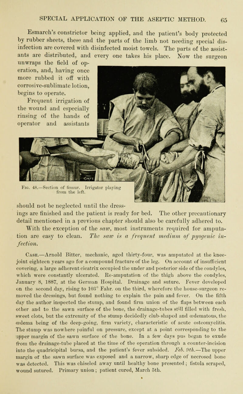 Esmarch's constrictor being applied, and the patient's body protected by rubber sheets, these and the parts of the limb not needing special dis- infection are covered with disinfected moist towels. The parts of the assist- ants are distributed, and every one takes his place. Now the surgeon unwraps the field of op- eration, and, having once more rubbed it off with corrosive-sublimate lotion, begins to operate. Frequent irrigation of the wound and especially rinsing of the hands of operator and assistants Fig. 48.—Section of femur. Irrigator playing from the left. should not be neglected until the dress- ings are finished and the patient is ready for bed. The other precautionary detail mentioned in a previous chapter should also be carefully adhered to. With the exception of the saw, most instruments required for amputa- tion are easy to clean. The saw is a frequent medium of pyogenic in- fection. Case.—Arnold Bitter, mechanic, aged thirty-four, was amputated at the knee- joint eighteen years ago for a compound fracture of the leg. On account of insufficient covering, a large adherent cicatrix occupied the under and posterior side of the condyles, which were constantly ulcerated. Re-amputation of the thigh above the condyles, January 8, 1887, at the German Hospital. Drainage and suture. Fever developed on the second day, rising to 103° Fahr. ou the third, wherefore the house-surgeon re- moved the dressings, but found nothing to explain the pain and fever. On the fifth day the author inspected the stump, and found firm union of the flaps between each other and to the sawn surface of the bone, the drainage-tubes still filled with fresh, sweet clots, but the extremity of the stump decidedly club-shaped and cedematous, the oedema being of the deep-going, firm variety, characteristic of acute osteomyelitis. The stump was nowhere painful on pressure, except at a point corresponding to the upper margin of the sawn surface of the bone. In a few days pus began to exude from the drainage-tube placed at the time of the operation through a counter-incision into the quadricipital bursa, and the patient's fever subsided. Feb. 9th.—The upper margin of the sawn surface was exposed and a narrow, sharp edge of necrosed bone was detected. This was chiseled away until healthy bone presented ; fistula scraped, wound sutured. Primary union; patient cured, March 5th.