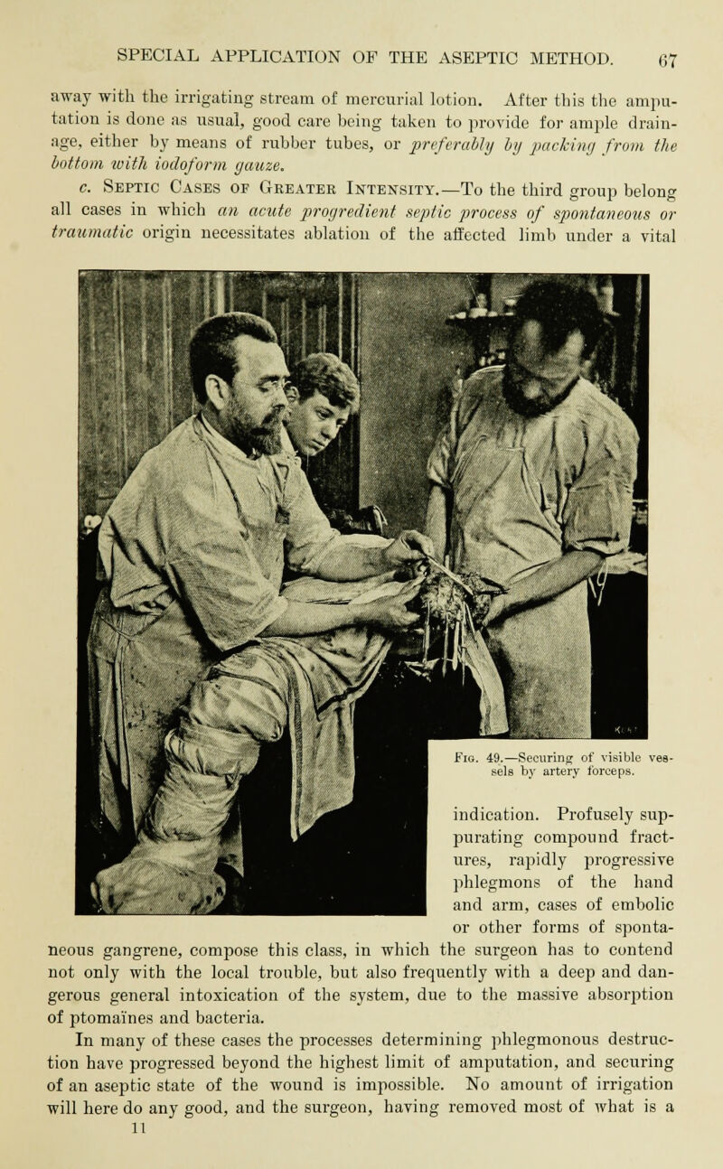 away with the irrigating stream of mercurial lotion. After this the ampu- tation is done as usual, good care being taken to provide for ample drain- age, either by means of rubber tubes, or preferably by packing from the bottom with iodoform gauze. c. Septic Cases of Greater Intensity.—To the third group belong all cases in which an acute progredient septic process of spontaneous or traumatic origin necessitates ablation of the affected limb under a vital Fig. 49.—Securing of visible ves- sels by artery forceps. indication. Profusely sup- purating compound fract- ures, rapidly progressive phlegmons of the hand and arm, cases of embolic or other forms of sponta- neous gangrene, compose this class, in which the surgeon has to contend not only with the local trouble, but also frequently with a deep and dan- gerous general intoxication of the system, due to the massive absorption of ptomaines and bacteria. In many of these cases the processes determining phlegmonous destruc- tion have progressed beyond the highest limit of amputation, and securing of an aseptic state of the wound is impossible. No amount of irrigation will here do any good, and the surgeon, having removed most of what is a 11