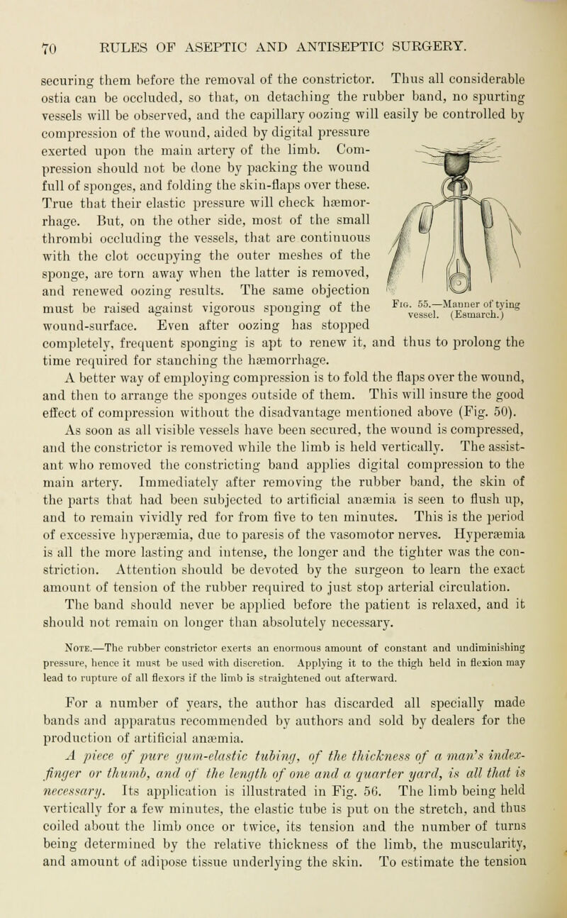 securing them before the removal of the constrictor. Thus all considerable ostia can be occluded, so that, on detaching the rubber band, no spurting vessels will be observed, and the capillary oozing will easily be controlled by compression of the wound, aided by digital pressure exerted upon the main artery of the limb. Com- pression should not be clone by packing the wound full of sponges, and folding the skin-flaps over these. True that their elastic pressure will check haemor- rhage. But, on the other side, most of the small thrombi occluding the vessels, that are continuous with the clot occupying the outer meshes of the sponge, are torn away when the latter is removed, and renewed oozing results. The same objection must be raised against vigorous sponging of the ^esser^EsmarchT1^ wound-surface. Even after oozing has stopped completely, frecpient sponging is apt to renew it, and thus to prolong the time required for stanching the haemorrhage. A better way of employing compression is to fold the flaps over the wound, and then to arrange the sponges outside of them. This will insure the good effect of compression without the disadvantage mentioned above (Fig. 50). As soon as all visible vessels have been secured, the wound is compressed, and the constrictor is removed while the limb is held vertically. The assist- ant who removed the constricting band applies digital compression to the main artery. Immediately after removing the rubber band, the skin of the parts that had been subjected to artificial anaemia is seen to flush up, and to remain vividly red for from five to ten minutes. This is the period of excessive hyperaernia, due to paresis of the vasomotor nerves. Hyperaemia is all the more lasting and intense, the longer and the tighter was the con- striction. Attention should be devoted by the surgeon to learn the exact amount of tension of the rubber required to just stop arterial circulation. The band should never be applied before the patient is relaxed, and it should not remain on longer than absolutely necessary. Note.—The rubber constrictor exerts an enormous amount of constant and undiminishing pressure, hence it must be used with discretion. Applying it to the thigh held in flexion may lead to rupture of all flexors if the limb is straightened out afterward. For a number of years, the author has discarded all specially made bands and apparatus recommended by authors and sold by dealers for the production of artificial anaemia. A piece of pure gum-elastic tubing, of the thickness of a man's index- finger or thumb, and of the length of one and a quarter yard, is all that is necessary. Its application is illustrated in Fig. 56. The limb being held vertically for a few minutes, the elastic tube is put on the stretch, and thus coiled about the limb once or twice, its tension and the number of turns being determined by the relative thickness of the limb, the muscularity, and amount of adipose tissue underlying the skin. To estimate the tension