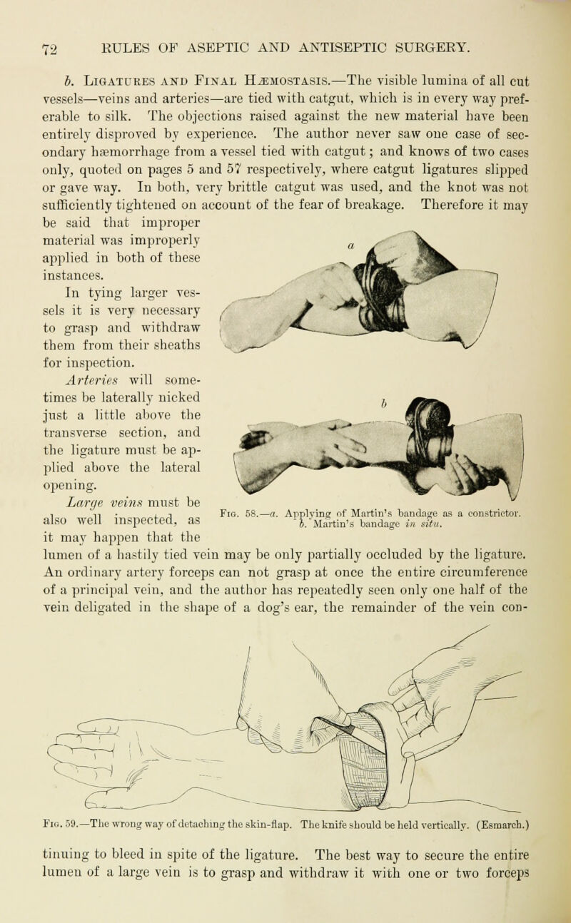 b. Ligatures and Final H^mostasis.—The visible lumina of all cut vessels—veins and arteries—are tied with catgut, which is in every way pref- erable to silk. The objections raised against the new material have been entirely disproved by experience. The author never saw one case of sec- ondary haemorrhage from a vessel tied with catgut; and knows of two cases only, quoted on pages 5 and 57 respectively, where catgut ligatures slipped or gave way. In both, very brittle catgut was used, and the knot was not sufficiently tightened on account of the fear of breakage. Therefore it may be said that improper material was improperly applied in both of these instances. In tying larger ves- sels it is very necessary to grasp and withdraw them from their sheaths for inspection. Arteries will some- times be laterally nicked just a little above the transverse section, and the ligature must be ap- plied above the lateral opening. Large veins must be also well inspected, as it may happen that the lumen of a hastily tied vein may be only partially occluded by the ligature. An ordinary artery forceps can not grasp at once the entire circumference of a principal vein, and the author has repeatedly seen only one half of the vein deligated in the shape of a dog's ear, the remainder of the vein con- m- Fig. 58.- Applying of Martin's bandage as a constrictor.  b. Martin's bandage in situ. Fig. 59.—The wrong way of detaching the skin-flap. The knife should be held vertically. (Esmareh.) tinuing to bleed in spite of the ligature. The best way to secure the entire lumen of a large vein is to grasp and withdraw it with one or two forceps