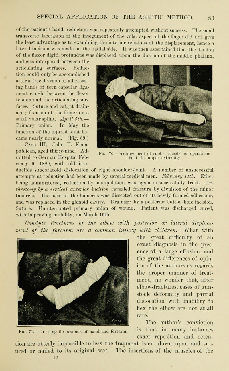 Fig. 70, Arrangement of rubber sheets for operations about the upper extremity. of the patient's hand, reduction was repeatedly attempted without success. The small transverse laceration of the integument of the volar aspect of the finger did not give the least advantage as to examining the interior relations of the displacement, hence a lateral incision was made on the radial side. It was then ascertained that the tendon of the flexor digit! profundus was displaced upon the dorsum of the middle phalanx, and was interposed between the articulating surfaces. Reduc- tion could only be accomplished after a free division of all resist- ing bands of torn capsular liga- ment, caught between the flexor tendon and the articulating sur- faces. Suture and catgut drain- age ; fixation of the finger on a small volar splint. April 5th.— Primary union. In May the function of the injured joint be- came nearly normal. (Fig. G9.) Case III.—John U. Kena, publican, aged thirty-nine. Ad- mitted to German Hospital Feb- ruary 9, 1889, with old irre- ducible subcoracoid dislocation of right shoulder-joint. A number of unsuccessful attempts at reduction had been made by several medical men. February 11th.—Ether being administered, reduction by manipulation was again unsuccessfully tried. Ar- throtomy by a vertical anterior incision revealed fracture by divulsion of the minor tubercle. The head of the humerus was dissected out of its newly-formed adhesions, and was replaced in the glenoid cavity. Drainage by a posterior button-hole incision. Suture. Uninterrupted primary union of wound. Patient was discharged cured, with improving mobility, on March 16th. Condyle fractures of the elbow with posterior or lateral displace- ment of the forearm are a common injury with children. What with the great difficult3r of an exact diagnosis in the pres- ence of a large effusion, and the great differences of opin- ion of the authors as regards the proper manner of treat- ment, no wonder that, after elbow-fractures, cases of gun- stock deformity and partial dislocation with inability to flex the elbow are not at all rare. The author's conviction is that in many instances exact reposition and reten- tion are utterly impossible unless the fragment is cut down upon and sut- ured or nailed to its original seat. The insertions of the muscles of the 1.3 Fig. 71.—Dressing for wounds of hand and forearm.