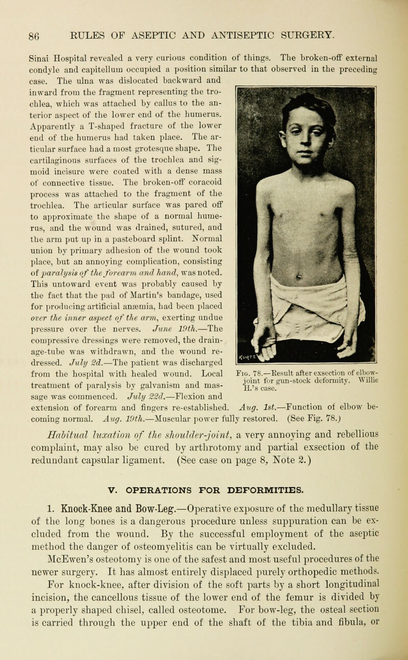 Sinai Hospital revealed a very curious condition of things. The broken-off external condyle and capitelluin occupied a position similar to that observed in the preceding case. The ulna was dislocated backward and inward from the fragment representing the tro- chlea, which was attached by callus to the an- terior aspect of the lower end of the humerus. Apparently a T-shaped fracture of the lower end of the humerus had taken place. The ar- ticular surface had a most grotesque shape. The cartilaginous surfaces of the trochlea and sig- moid incisure were coated with a dense mass of connective tissue. The broken-off coracoid process was attached to the fragment of the trochlea. The articular surface was pared off to approximate the shape of a normal hume- rus, and the wound was drained, sutured, and the arm put up in a pasteboard splint. Normal union by primary adhesion of the wound took place, but an annoying complication, consisting of paralysis of the forearm and hand, was noted. This untoward event was probably caused by the fact that the pad of Martin's bandage, used for producing artificial anaemia, had been placed over the inner aspect of the arm, exerting undue pressure over the nerves. June 19th.—The compressive dressings were removed, the drain- age-tube was withdrawn, and the wound re- dressed. July 2d.—The patient was discharged from the hospital with healed wound. Local treatment of paralysis by galvanism and mas- sage was commenced. July 22d.—Flexion and extension of forearm and fingers re-established. Aug. 1st.—Function of elbow be- coming normal. Aug. 19th.—Muscular power fully restored. (See Fig. 78._) Habitual luxation of the shoulder-joint, a very annoying and rebellious complaint, may also be cured by arthrotomy and partial exsection of the redundant capsular ligament. (See case on page 8, Note 2.) Fig. 78.—Eesult after exsection of elbow- joint for gun-stock deformity. Willie 11.'s case. V. OPERATIONS FOR DEFORMITIES. 1. Knock-Knee and Bow-Leg.—Operative exposure of tbe medullary tissue of the long bones is a dangerous procedure unless suppuration can be ex- cluded from the wound. By the successful employment of the aseptic method the danger of osteomyelitis can be virtually excluded. McEwen's osteotomy is one of the safest and most useful procedures of the newer surgery. It has almost entirely displaced purely orthopedic methods. For knock-knee, after division of the soft parts by a short longitudinal incision, the cancellous tissue of the lower end of the femur is divided by a properly shaped chisel, called osteotome. For bow-leg, the osteal section is carried through the upper end of the shaft of the tibia and fibula, or