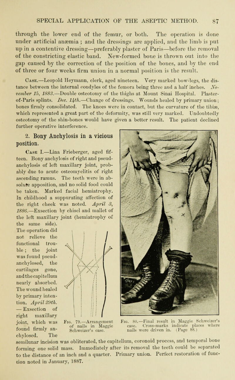 through the lower end of the femur, or both. The operation is done under artificial anaemia ; and the dressings are applied, and the limb is put up in a contentive dressing—preferably plaster of Paris—before the removal of the constricting elastic band. New-formed bone is thrown out into the gap caused by the correction of the position of the bones, and by the end of three or four weeks firm union in a normal position is the result. Case.—Leopold Heymann, clerk, aged nineteen. Very marked bow-legs, the dis- tance between the internal condyles of the femora being three and a half inches. No- vember 15, 18S3.—Double osteotomy of the thighs at Mount Sinai Hospital. Plaster- of-Paris splints. Dee. 14th.—Change of dressings. Wounds healed by primary union; bones firmly consolidated. The knees were in contact, but the curvature of the tibiae, which represented a great part of the deformity, was still very marked. Undoubtedly osteotomy of the shin-bones would have given a better result. The patient declined further operative interference. 2. Bony Anchylosis in a vicious position. Case I.—Lina Frieberger, aged fif- teen. Bony anchylosis of right and pseud- anchylosis of left maxillary joint, prob- ably due to acute osteomyelitis of right ascending ramus. The teeth were in ab- solute apposition, and no solid food could be taken. Marked facial hemiatrophy. In childhood a suppurating affection of the right cheek was noted. April 3, 1886.—Exsection by chisel and mallet of the left maxillary joint (hemiatrophy of the same side). The operation did not relieve the functional trou- ble ; the joint was found pseud- ancbylosed, the cartilages gone, andthecapitellum nearly absorbed. The wound healed by primary inten- tion. April 29th. — Exsection of right maxillary joint, which was found firmly an- chylosed. The semilunar incision was obliterated, the capitellum, coronoid process, and temporal bone forming one solid mass. Immediately after its removal the teeth could be separated to the distance of an inch and a quarter. Primary union. Perfect restoration of func- tion noted in January, 1887. Fig. 79.—Arrangement of nails in Maggie Schweizer's case. Fig. 80.—Final result in Maggie Schweizer's ease. Cross-marks indicate places where nails were driven in. | Page 88.)