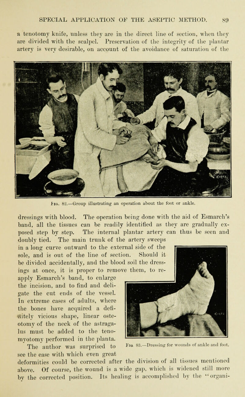 a tenotomy knife, unless they are in the direct line of section, when they are divided with the scalpel. Preservation of the integrity of the plantar artery is very desirable, on account of the avoidance of saturation of the i iq. 82.—Group illustrating an operation about the foot or ankle. dressings with blood. The operation being done with the aid of Esmarch's band, all the tissues can be readily identified as they are gradually ex- posed step by step. The internal plantar artery can thus be seen and doubly tied. The main trunk of the artery sweeps in a long curve outward to the external side of the sole, and is out of the line of section. Should it be divided accidentally, and the blood soil the dress- ings at once, it is proper to remove them, to re- apply Esmarch's band, to enlarge the incision, and to find and deli- gate the cut ends of the vessel. In extreme cases of adults, where the bones have acquired a defi- rtitely vicious shape, linear oste- otomy of the neck of the astraga- lus must be added to the teno- myotomy performed in the planta. The author was surprised to see the ease with which even great deformities could be corrected after the division of all tissues mentioned above. Of course, the wound is a wide gap, which is widened still more bv the corrected position. Its healing is accomplished by the organi-