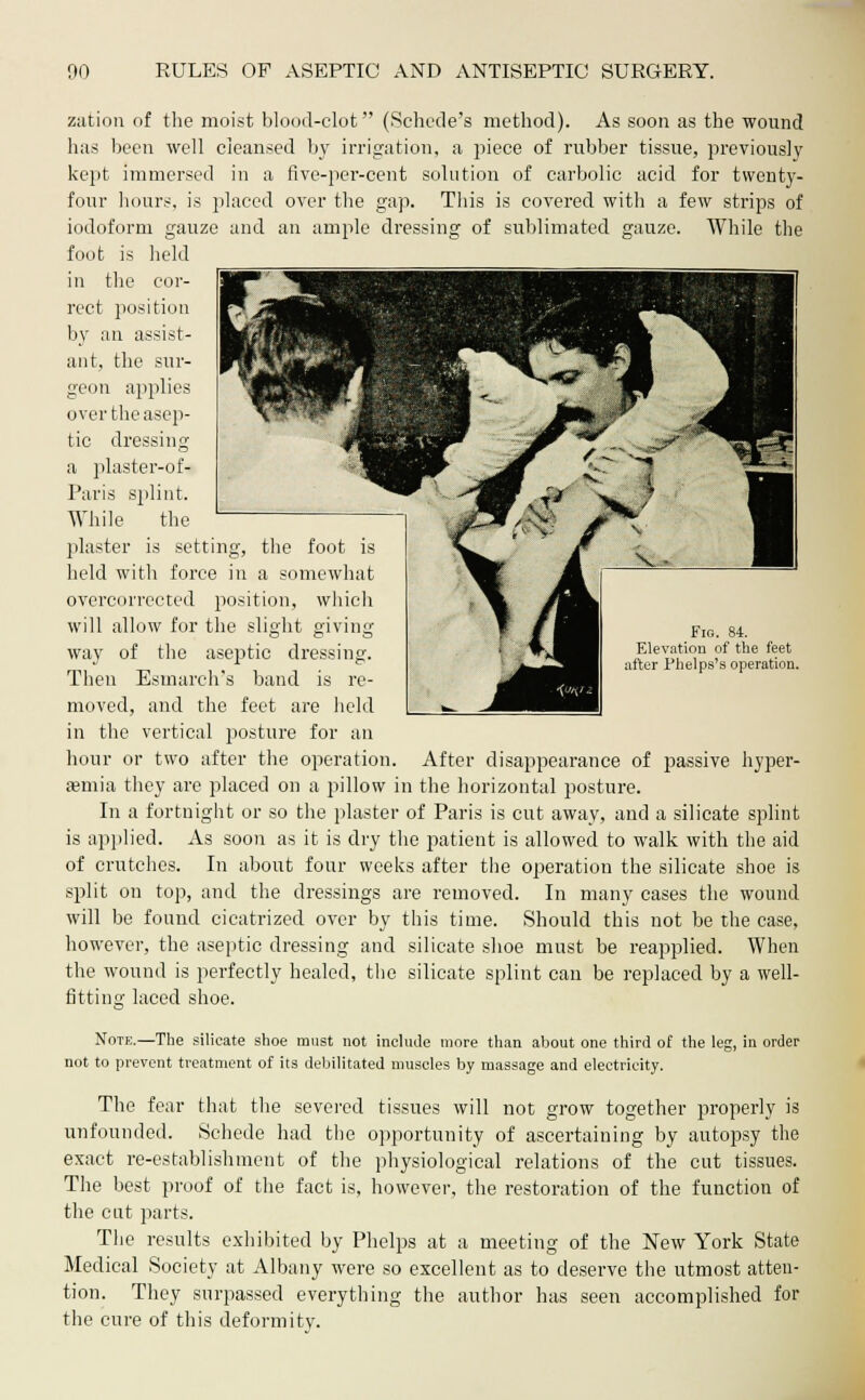 zation of the moist blood-clot (Schede's method). As soon as the wound has been well cleansed by irrigation, a piece of rubber tissue, previously kept immersed in a five-per-cent solution of carbolic acid for twenty- four hours, is placed over the gap. This is covered with a few strips of iodoform gauze and an ample dressing of sublimated gauze. While the foot is held in the cor- rect position by an assist- ant, the sur- geon applies over the asep- tic dressin a plaster-of- Paris splint. While the plaster is setting, the foot is held with force in a somewhat overcorrected position, which will allow for the slight giving way of the aseptic dressing. re- held Fig. 84. Elevation of the feet after Phelps's operation. Then Esmarch's band moved, and the feet are in the vertical posture for an hour or two after the operation. After disappearance of passive hyper- emia they are placed on a pillow in the horizontal posture. In a fortnight or so the plaster of Paris is cut away, and a silicate splint is applied. As soon as it is dry the patient is allowed to walk with the aid of crutches. In about four weeks after the operation the silicate shoe is split on top, and the dressings are removed. In many cases the wound will be found cicatrized over by this time. Should this not be the case, however, the aseptic dressing and silicate shoe must be reapplied. When the wound is perfectly healed, the silicate splint can be replaced by a well- fittino- laced shoe. Note.—The silicate shoe must not include more than about one third of the leg, in order not to prevent treatment of its debilitated muscles by massage and electricity. The fear that the severed tissues will not grow together properly is unfounded. Schede had the opportunity of ascertaining by autopsy the exact re-establishment of the physiological relations of the cut tissues. The best proof of the fact is, however, the restoration of the function of the cut parts. The results exhibited by Phelps at a meeting of the New York State Medical Society at Albany were so excellent as to deserve the utmost atten- tion. They surpassed everything the author has seen accomplished for the cure of this deformity.