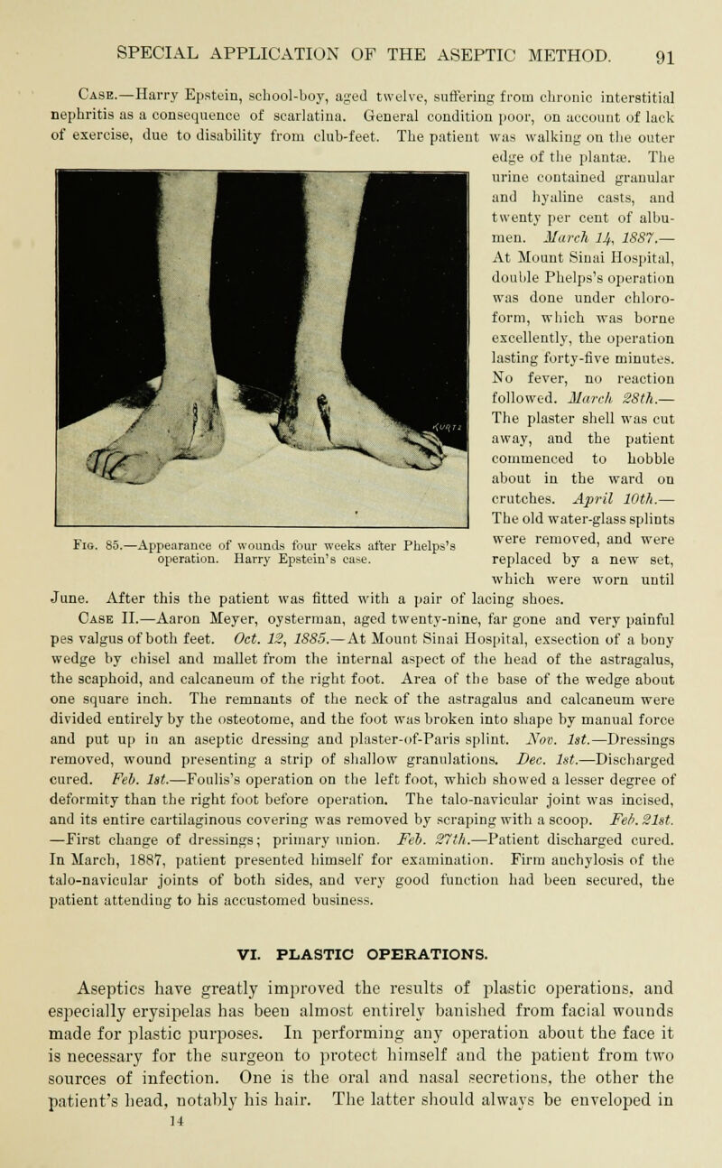 Case.—Harry Epstein, school-boy, aged twelve, suffering from chronic interstitial nephritis as a consequence of scarlatina. General condition poor, on account of lack of exercise, due to disability from club-feet. The patient was walking on the outer edge of the plantas. The urine contained granular and hyaline casts, and twenty per cent of albu- men. March 14, 1SS7.— At Mount Sinai Hospital, double Phelps's operation was done under chloro- form, which was borne excellently, the operation lasting forty-five minutes. No fever, no reaction followed. March 28th.— The plaster shell was cut away, and the patient commenced to hobble about in the ward on crutches. April 10th.— The old water-glass splints were removed, and were replaced by a new set, which were worn until June. After this the patient was fitted with a pair of lacing shoes. Case II.—Aaron Meyer, oysterman, aged twenty-nine, far gone and very painful pes valgus of both feet. Oct. 12, 1885.—At Mount Sinai Hospital, exsection of a bony wedge by chisel and mallet from the internal aspect of the head of the astragalus, the scaphoid, and calcaneum of the right foot. Area of the base of the wedge about one square inch. The remnants of the neck of the astragalus and calcaneum were divided entirely by the osteotome, and the foot was broken into shape by manual force and put up in an aseptic dressing and plaster-of-Paris splint. Nov. 1st.—Dressings removed, wound presenting a strip of shallow granulations. Dec. 1st.—Discharged cured. Feb. 1st.—Foulis's operation on the left foot, which showed a lesser degree of deformity than the right foot before operation. The talo-navicular joint was incised, and its entire cartilaginous covering was removed by scraping with a scoop. Feb. 21st. —First change of dressings; primary union. Feb. 27th.—Patient discharged cured. In March, 1887, patient presented himself for examination. Firm anchylosis of the talo-navicular joints of both sides, and very good function had been secured, the patient attendiug to his accustomed business. Fig. 85.—Appearance of wounds four weeks after Phelps's operation. Harry Epstein's ease. VI. PLASTIC OPERATIONS. Aseptics have greatly improved the results of plastic operations, and especially erysipelas has been almost entirely banished from facial wounds made for plastic purposes. In performing any operation about the face it is necessary for the surgeon to protect himself and the patient from two sources of infection. One is the oral and nasal secretions, the other the patient's head, notably his hair. The latter should always be enveloped in 14