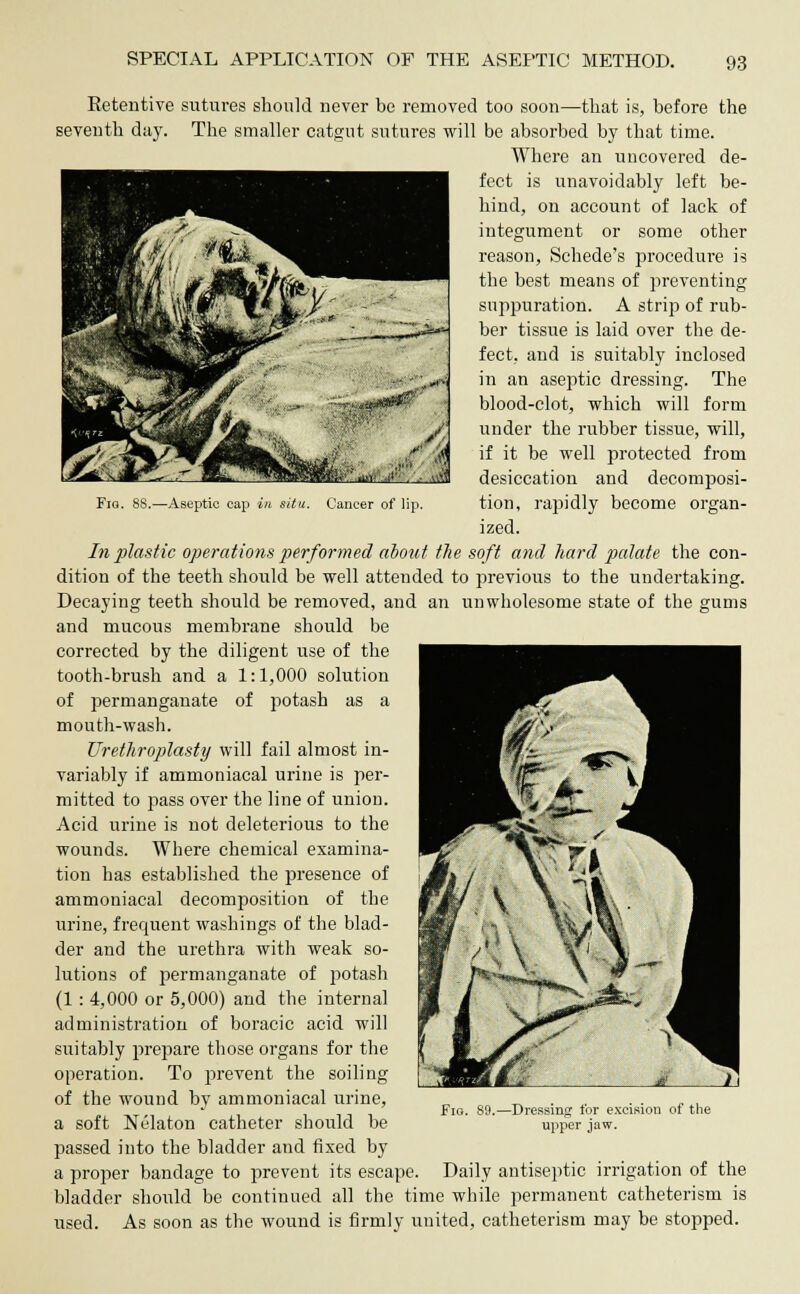 Fig. 88.—Aseptic cap in situ. Cancer of lip. Retentive sutures should never be removed too soon—that is, before the seventh day. The smaller catgut sutures will be absorbed by that time. Where an uncovered de- fect is unavoidably left be- hind, on account of lack of integument or some other reason, Schede's procedure is the best means of preventing suppuration. A strip of rub- ber tissue is laid over the de- fect, and is suitably inclosed in an aseptic dressing. The blood-clot, which will form under the rubber tissue, will, if it be well protected from desiccation and decomposi- tion, rapidly become organ- ized. In plastic operations performed about the soft and hard palate the con- dition of the teeth should be well attended to previous to the undertaking. Decaying teeth should be removed, and an unwholesome state of the gums and mucous membrane should be corrected by the diligent use of the tooth-brush and a 1:1,000 solution of permanganate of potash as a mouth-wash. Urethroplasty will fail almost in- variably if ammoniacal urine is per- mitted to pass over the line of union. Acid urine is not deleterious to the wounds. Where chemical examina- tion has established the presence of ammoniacal decomposition of the urine, frequent washings of the blad- der and the urethra with weak so- lutions of permanganate of potash (1 : 4,000 or 5,000) and the internal administration of boracic acid will suitably prepare those organs for the operation. To prevent the soiling of the wound by ammoniacal urine, a soft Nelaton catheter should be passed into the bladder and fixed by a proper bandage to prevent its escape. Daily antiseptic irrigation of the bladder should be continued all the time while permanent catheterism is used. As soon as the wound is firmly united, catheterism may be stopped. Fig. 89. -Dressing for excision of the upper jaw.